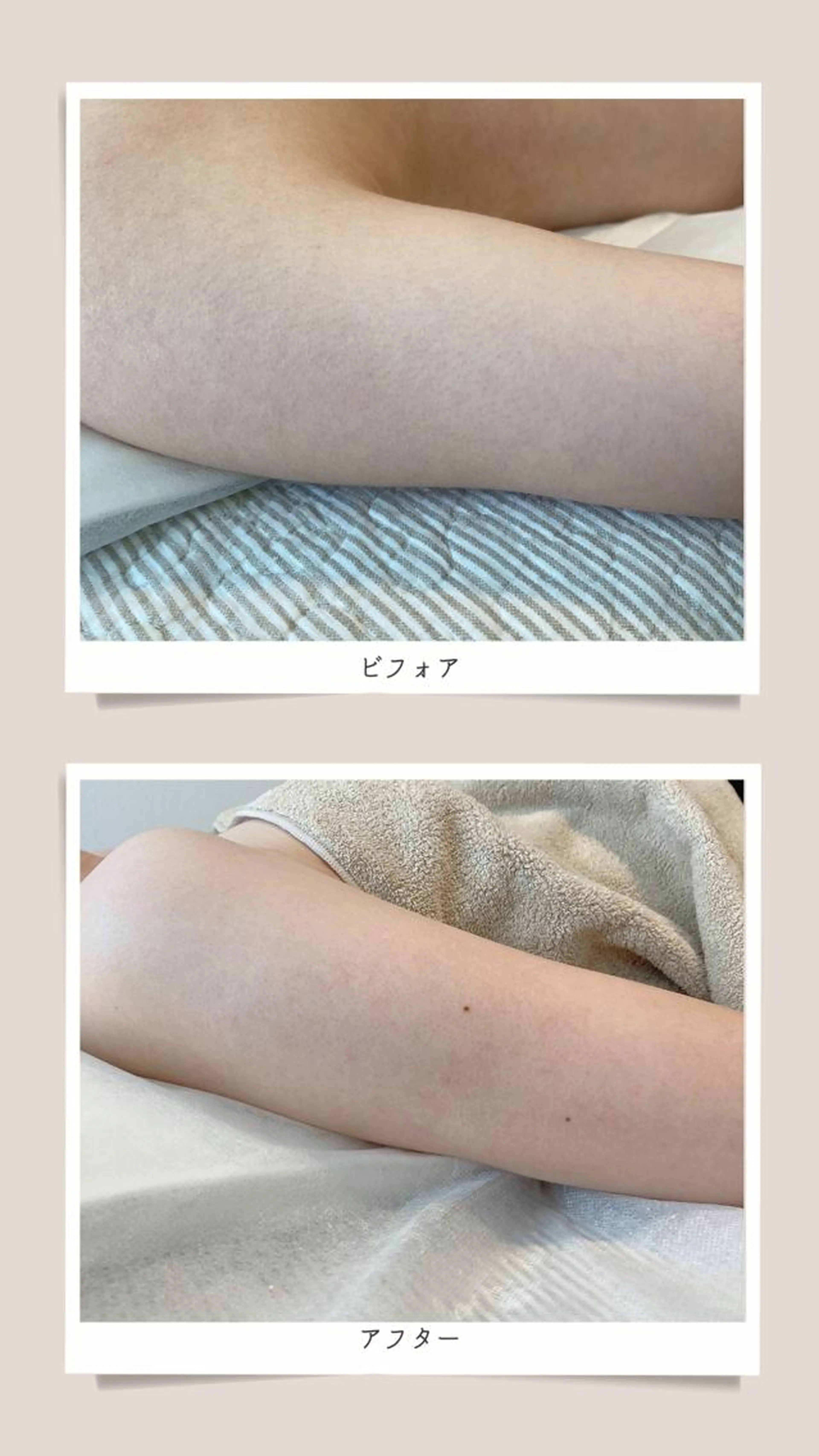 ひじ下（手指含/両腕） ※自己処理なしでお越しください.の写真