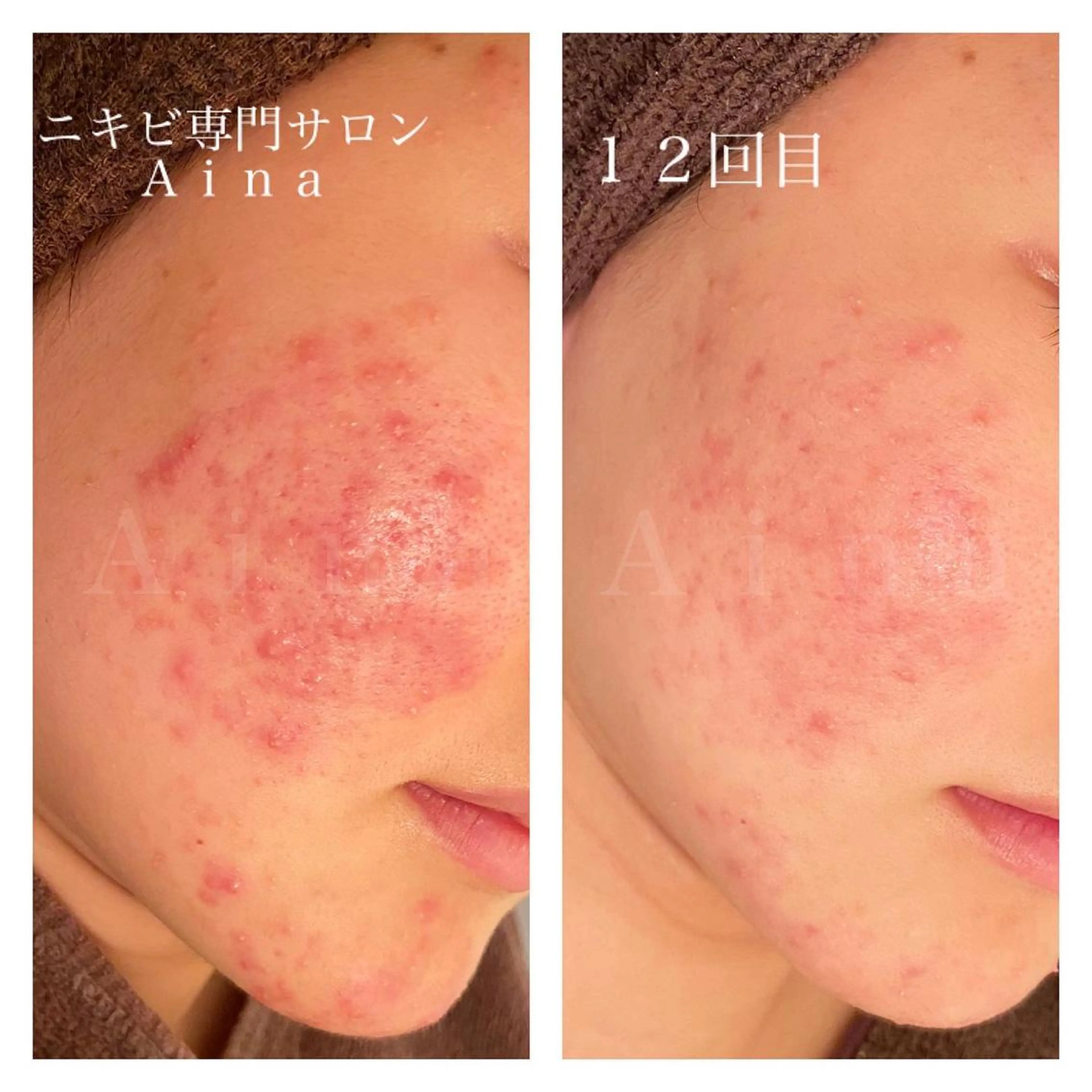 ショート カラー パーマ ヘアアレンジ メンズ キッズ ネイル マツエク・マツパ ニキビ跡専門サロン Ainaのエステ・リラクイメージ