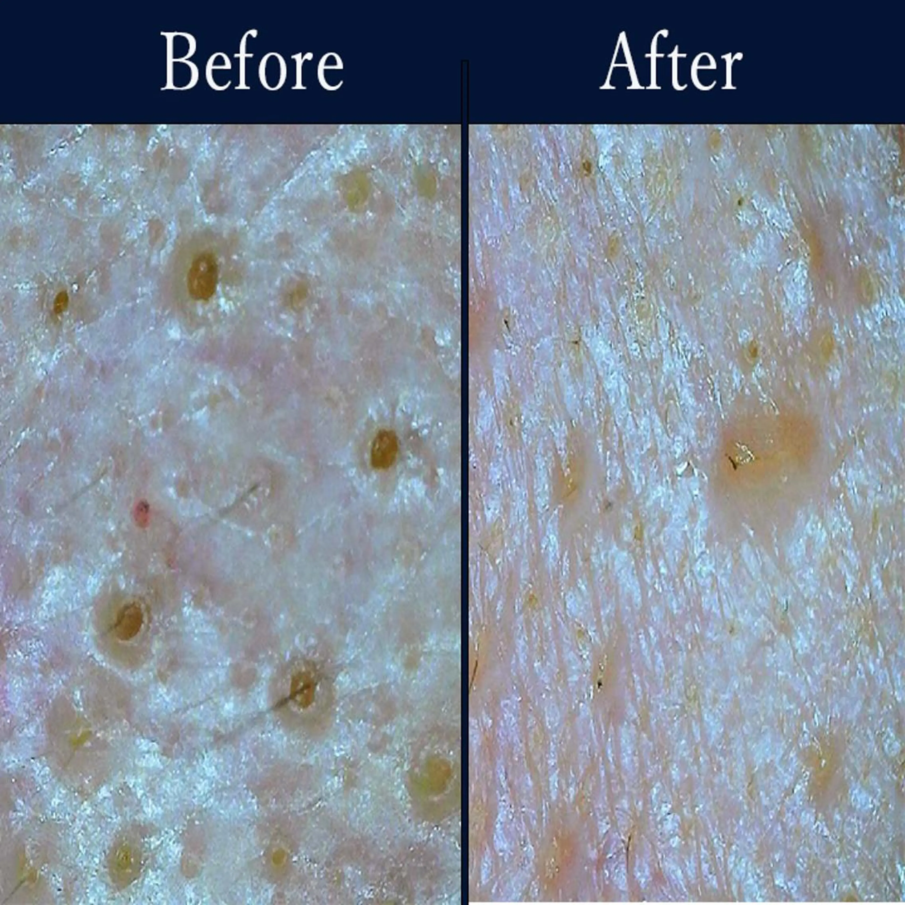 【毛穴洗浄/ざらつき/黒ずみ】毛穴すっきり洗浄+保湿ケア ¥4,980の写真