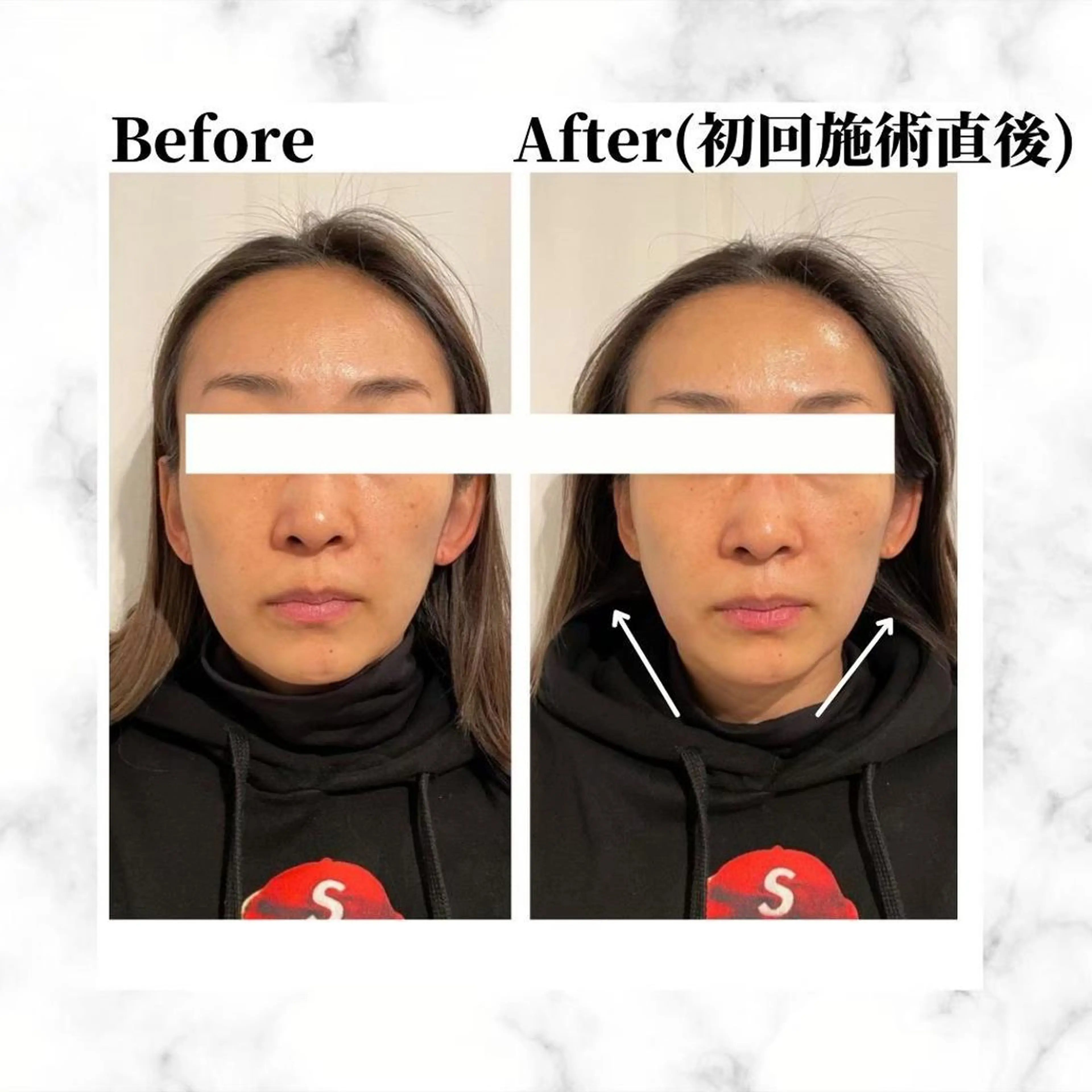 12Dハイフ💗 最強小顔のエステ・リラクイメージ