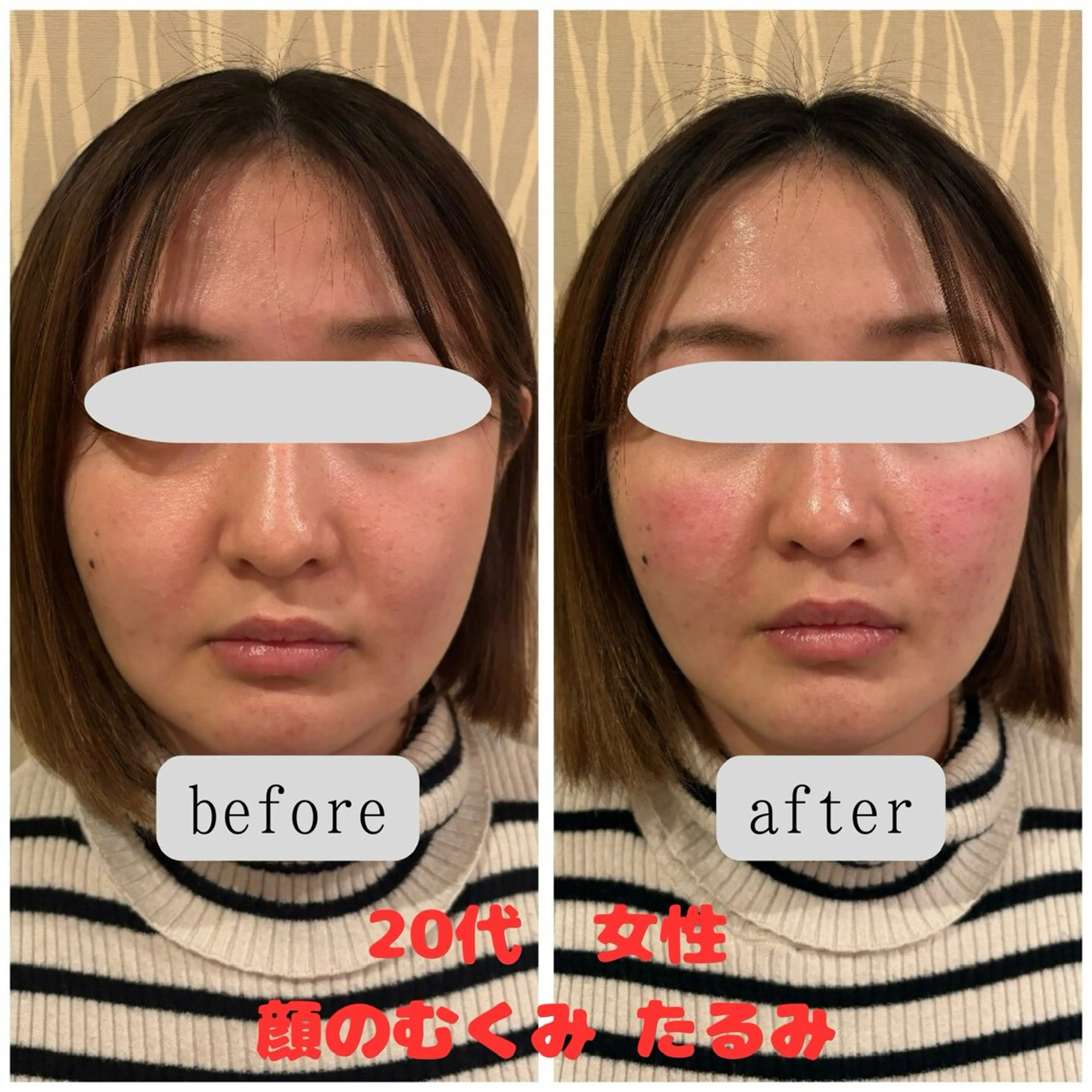 【人気No.2】2回目以降 プレミアム美容鍼の写真