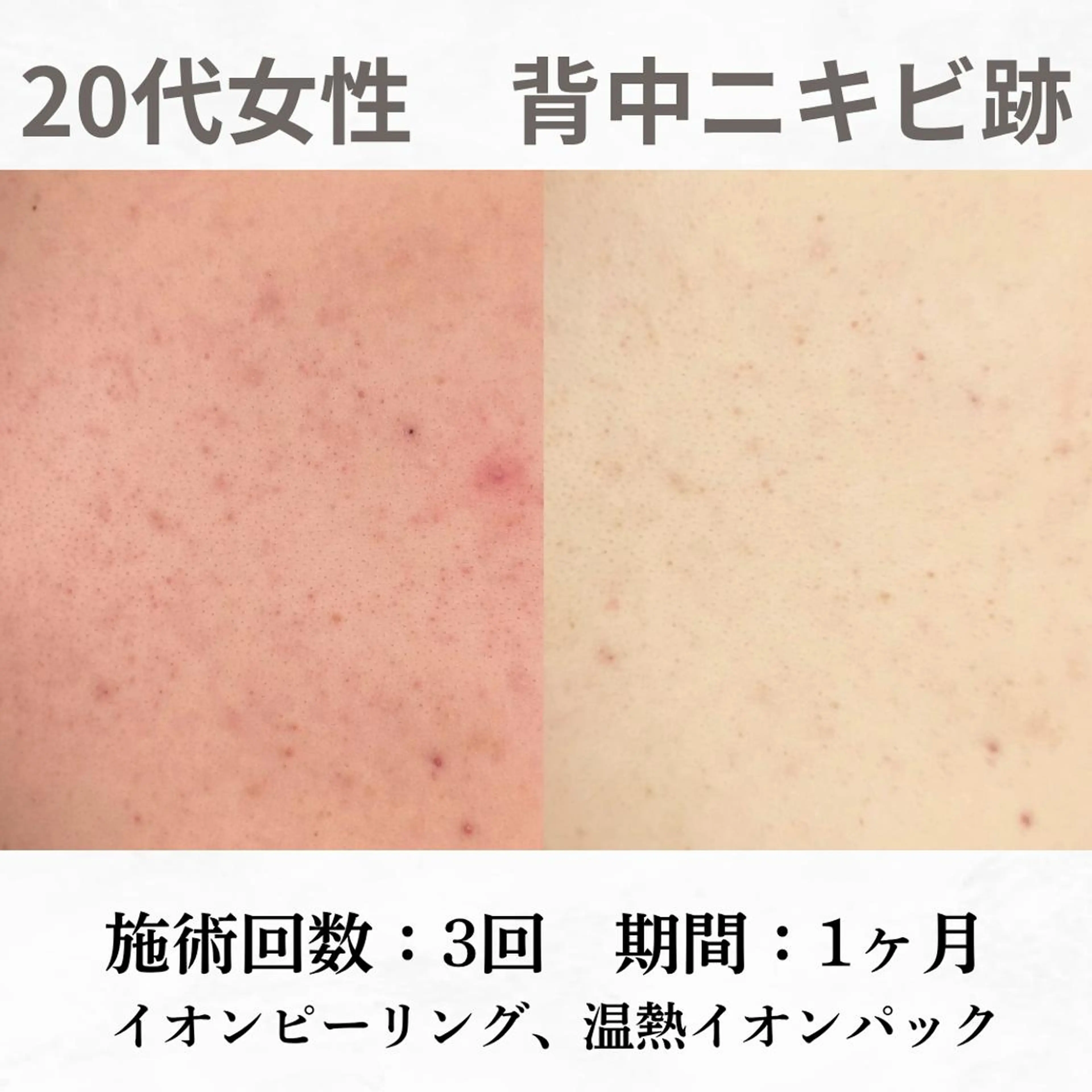 重度ニキビ専門🌷 ダウンタイムなしのエステ・リラクイメージ