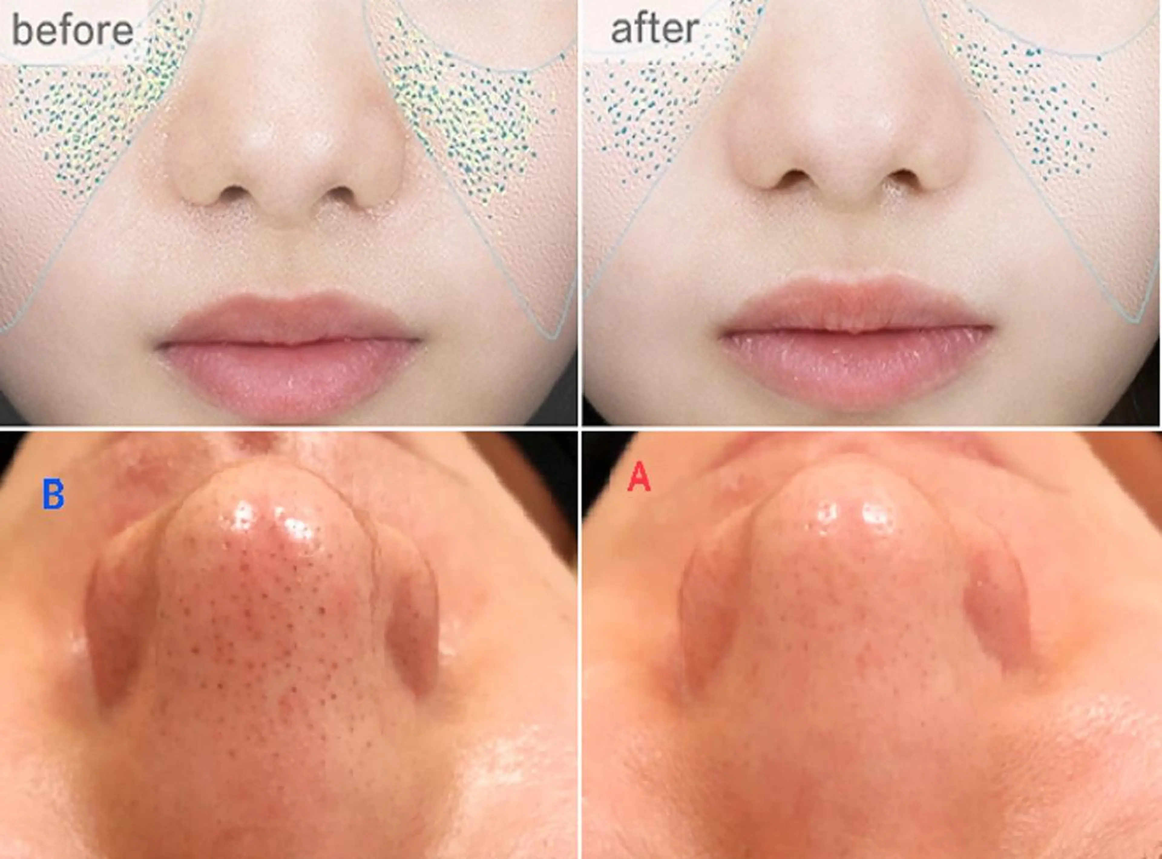 【毛穴集中ケア】Ｗフェイシャルで毛穴徹底ケア＆肌修復で毛穴レスな水光肌♪2回目以降はIPL光美容を全回数無料の写真