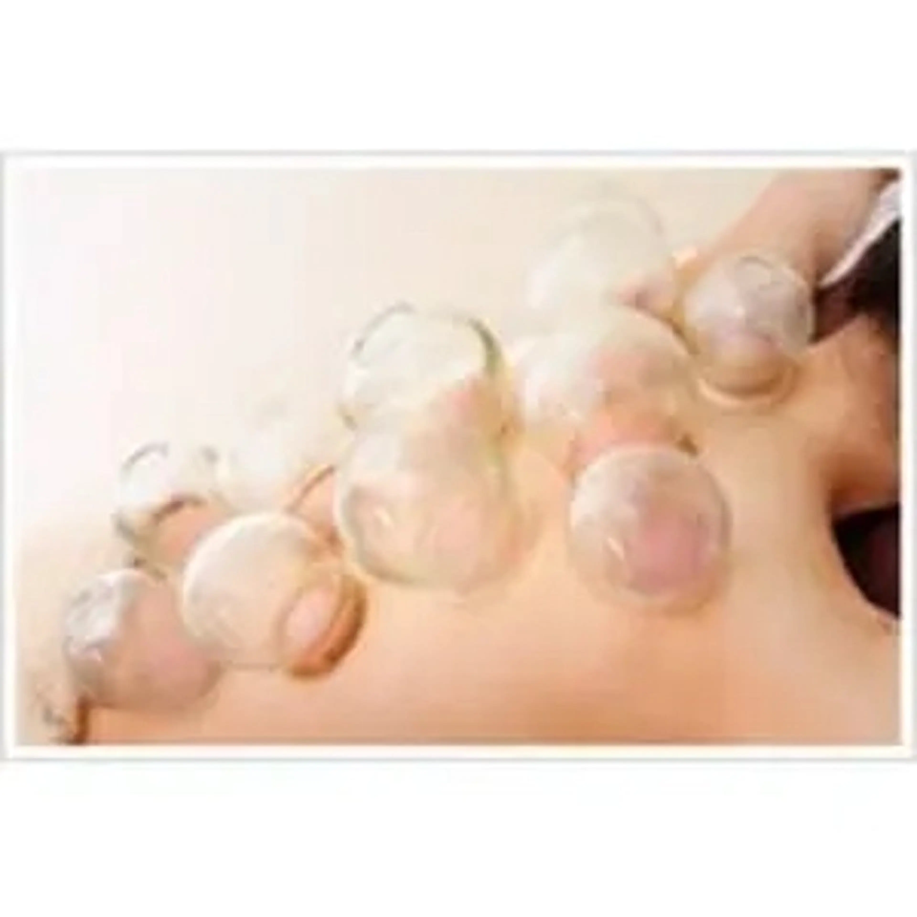 季節吸玉おすすめ！吸玉20分＋全身美容矯正90分 ￥9,990の写真