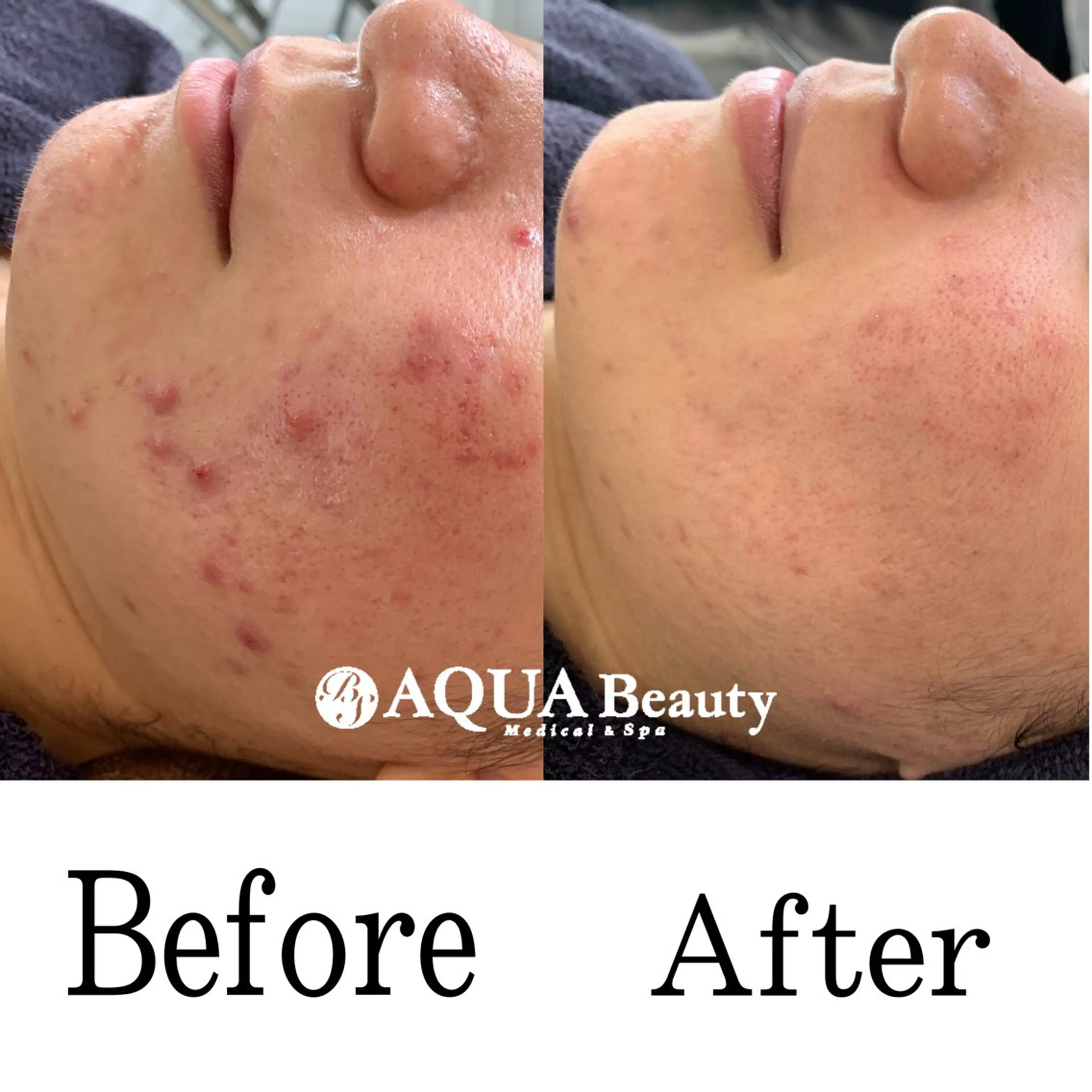 新生活応援🌸毛穴ごっそり革命コース🫧の写真