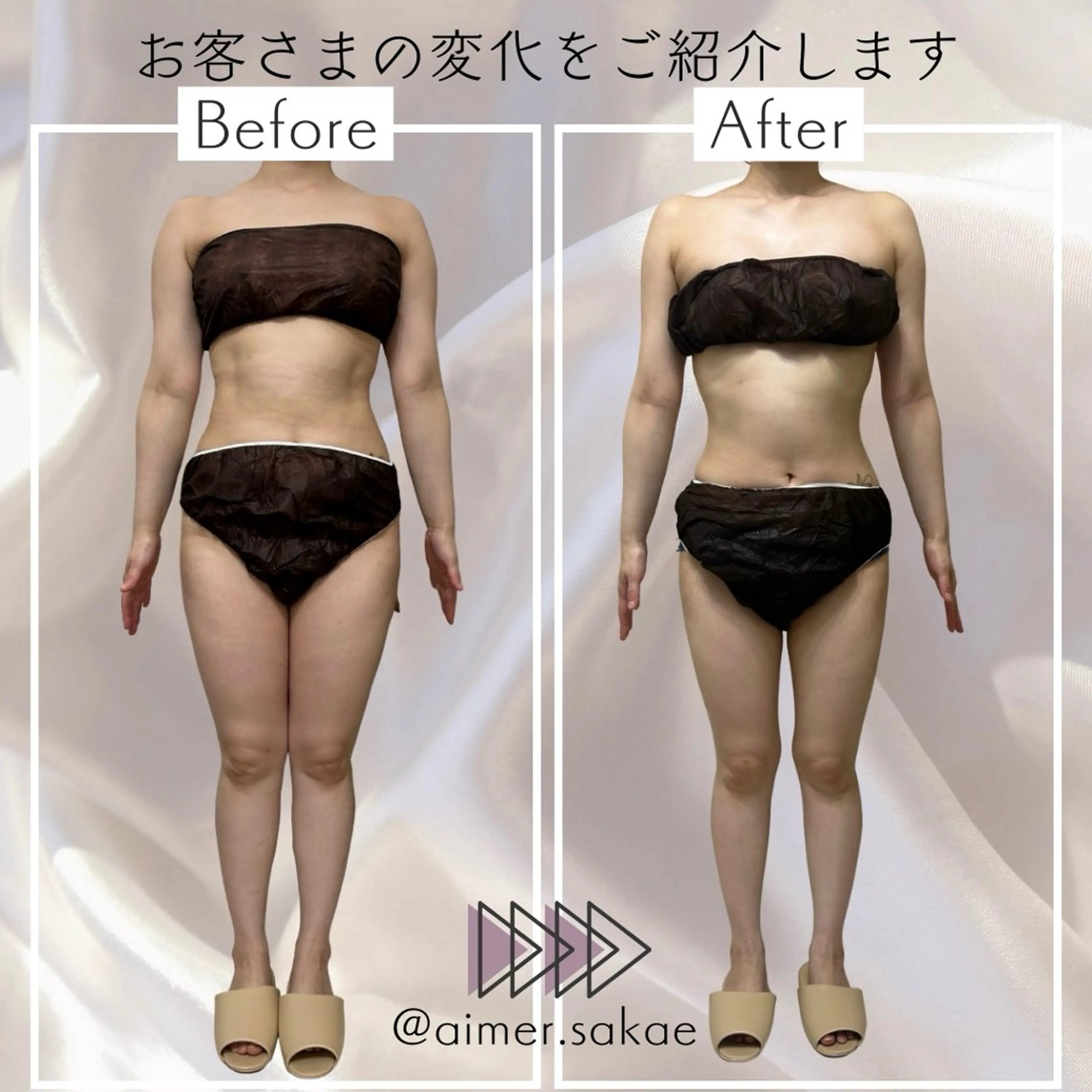 【全身本気痩せ🔥】全身ハイパーナイフ＋リンパマッサージ70分の写真