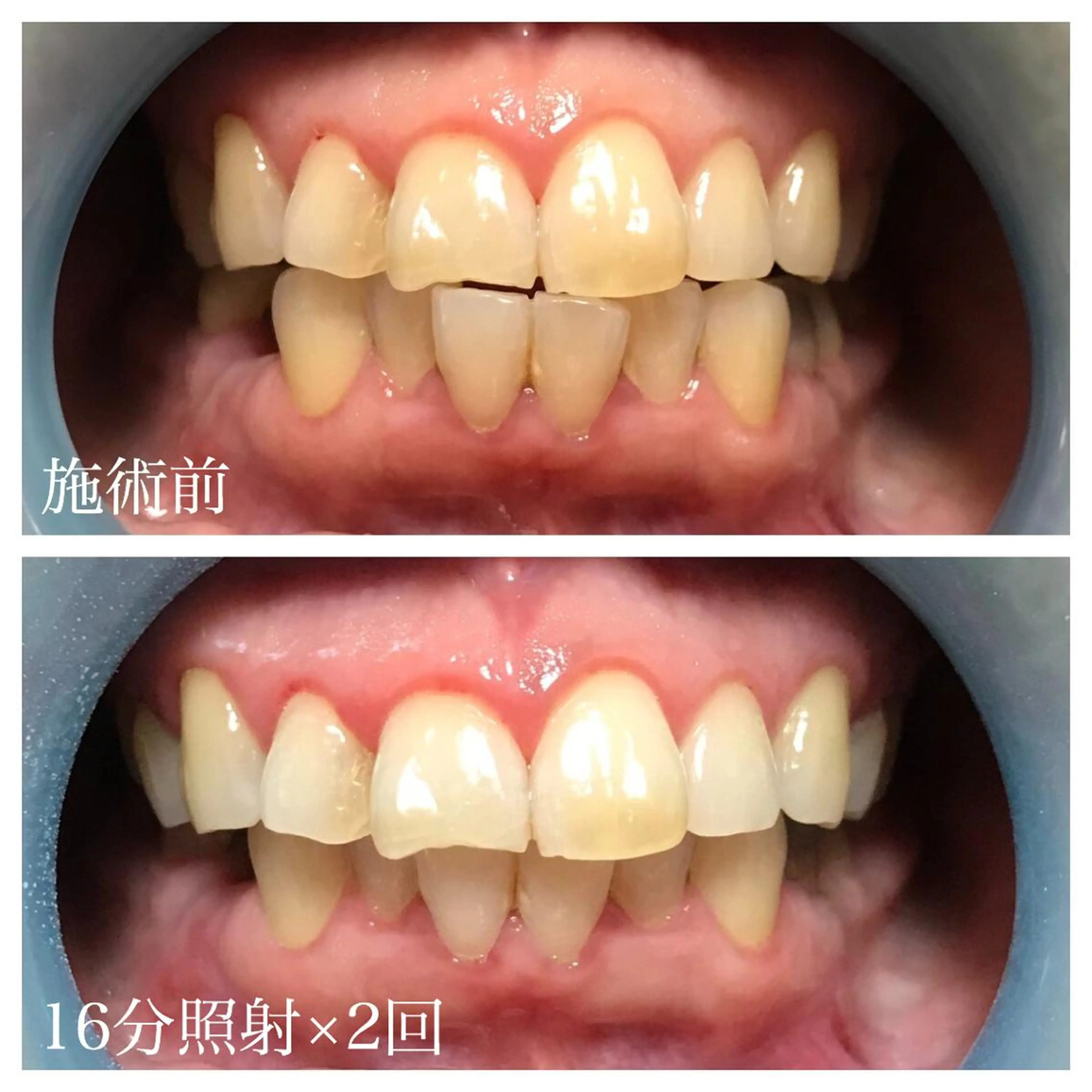 ネイル/耳つぼ /新ホワイトニングのネイルデザイン