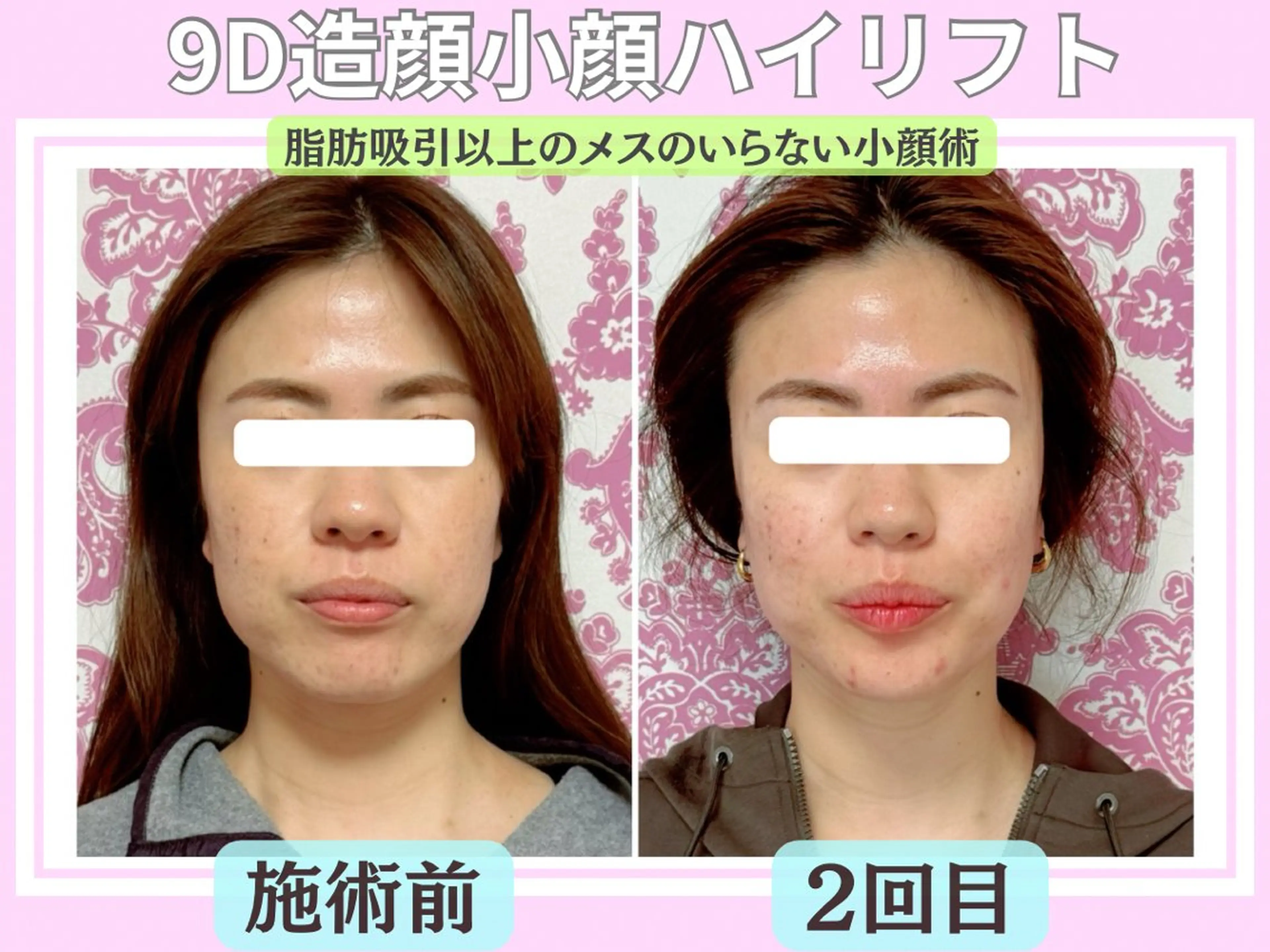 毛穴レス ハーブ＆ ワックス脱毛×光脱毛のエステ・リラクイメージ