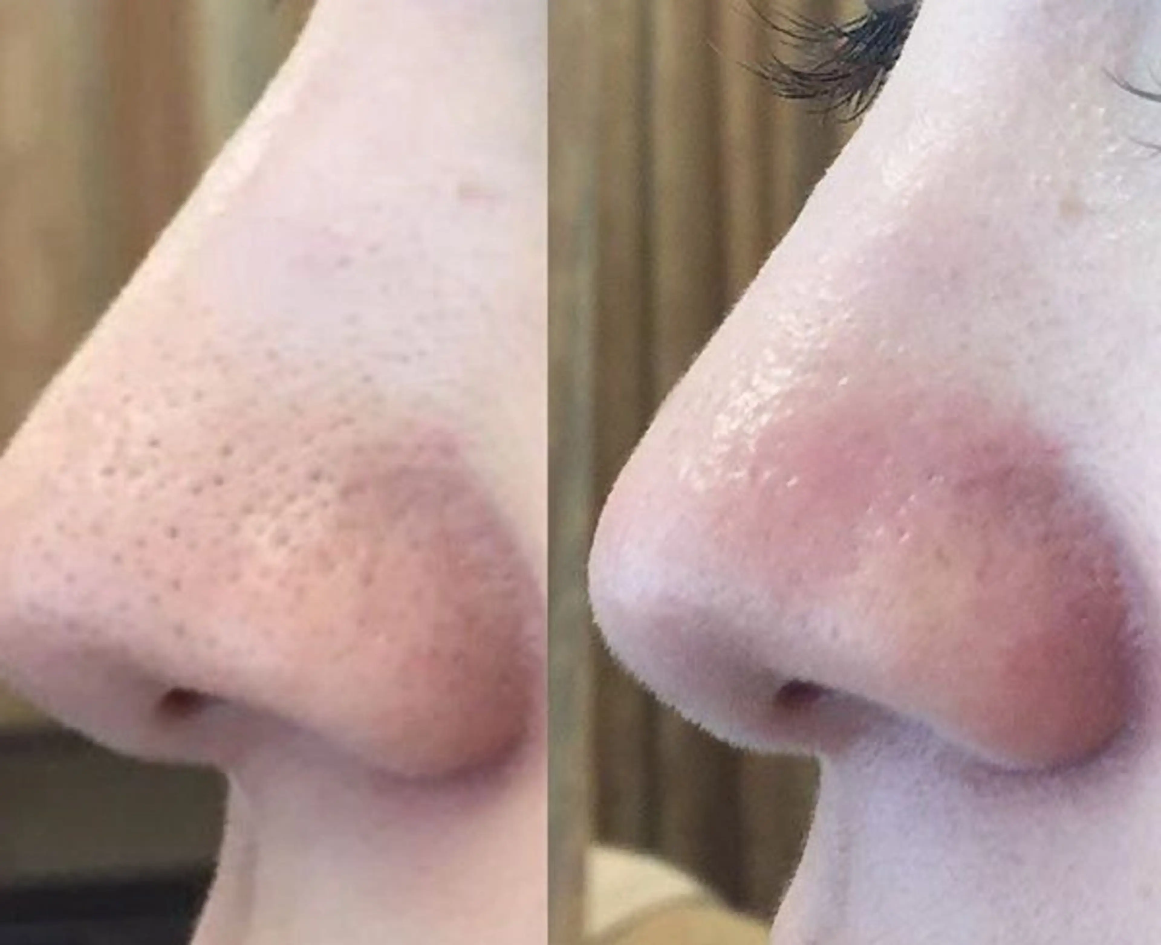 ずっと綺麗にならない鼻の角栓大掃除‼️とにかく鼻だけ即綺麗にするメニュー👃の写真