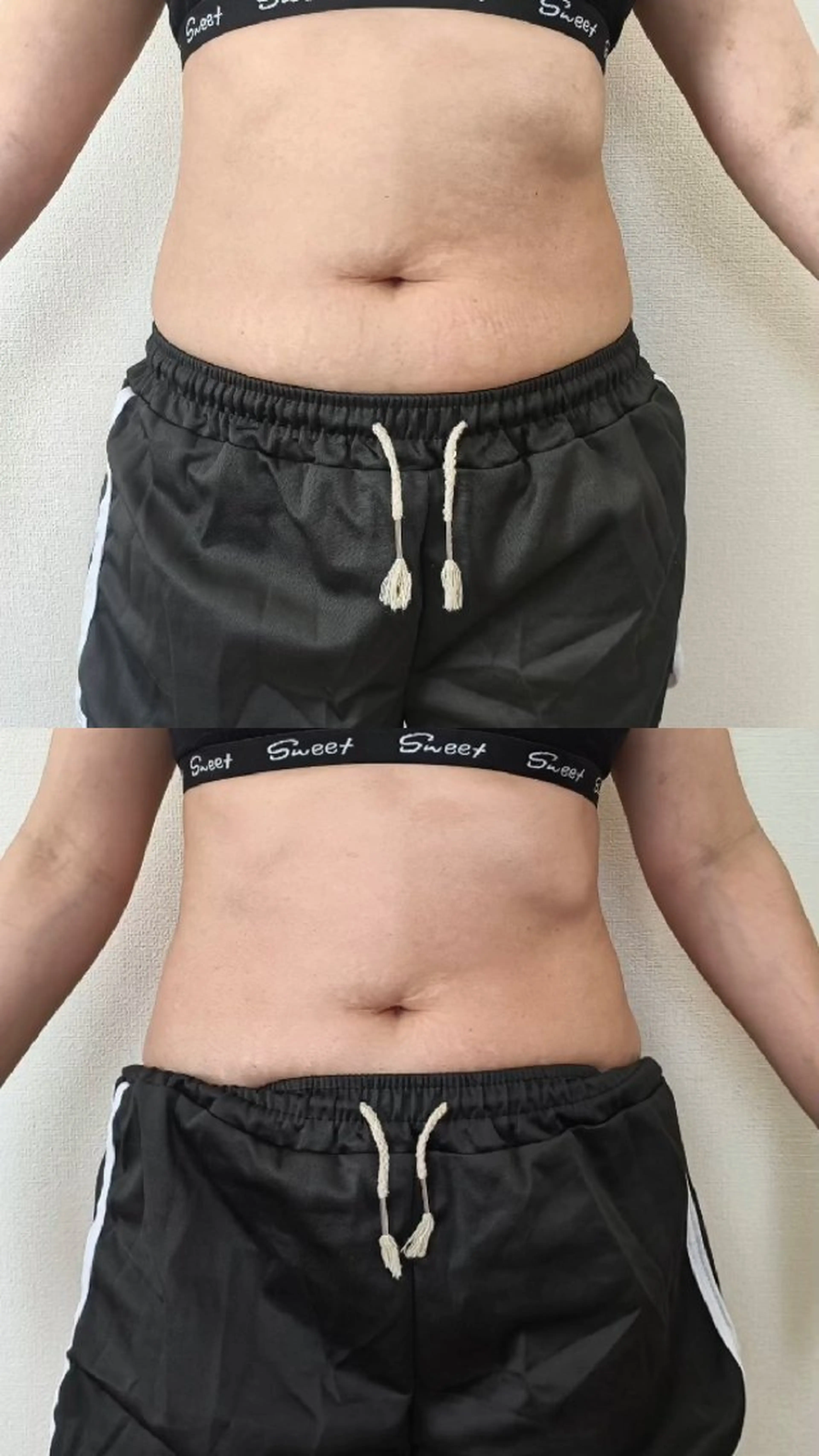 2回目以降の方【10名限定🔥】集中痩身キャビコース|45分1部位 通常1回6,000円が5,500円の5回コース!!の写真