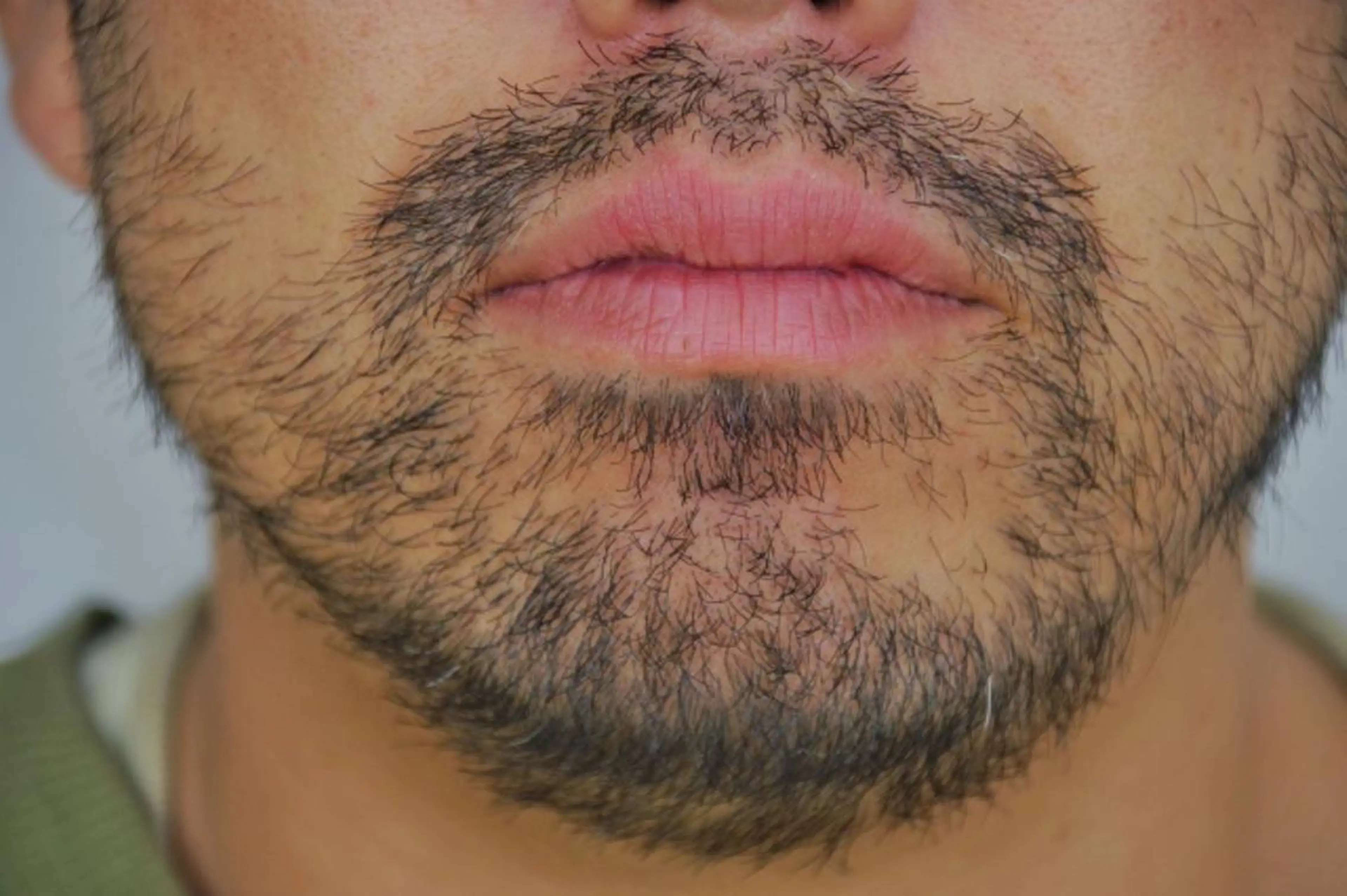 【脱毛無料相談】ご希望部位にトライアル☆最新脱毛機器導入☆カウンセリング後お好きな部位に(VIO以外)10ショットお試しの写真