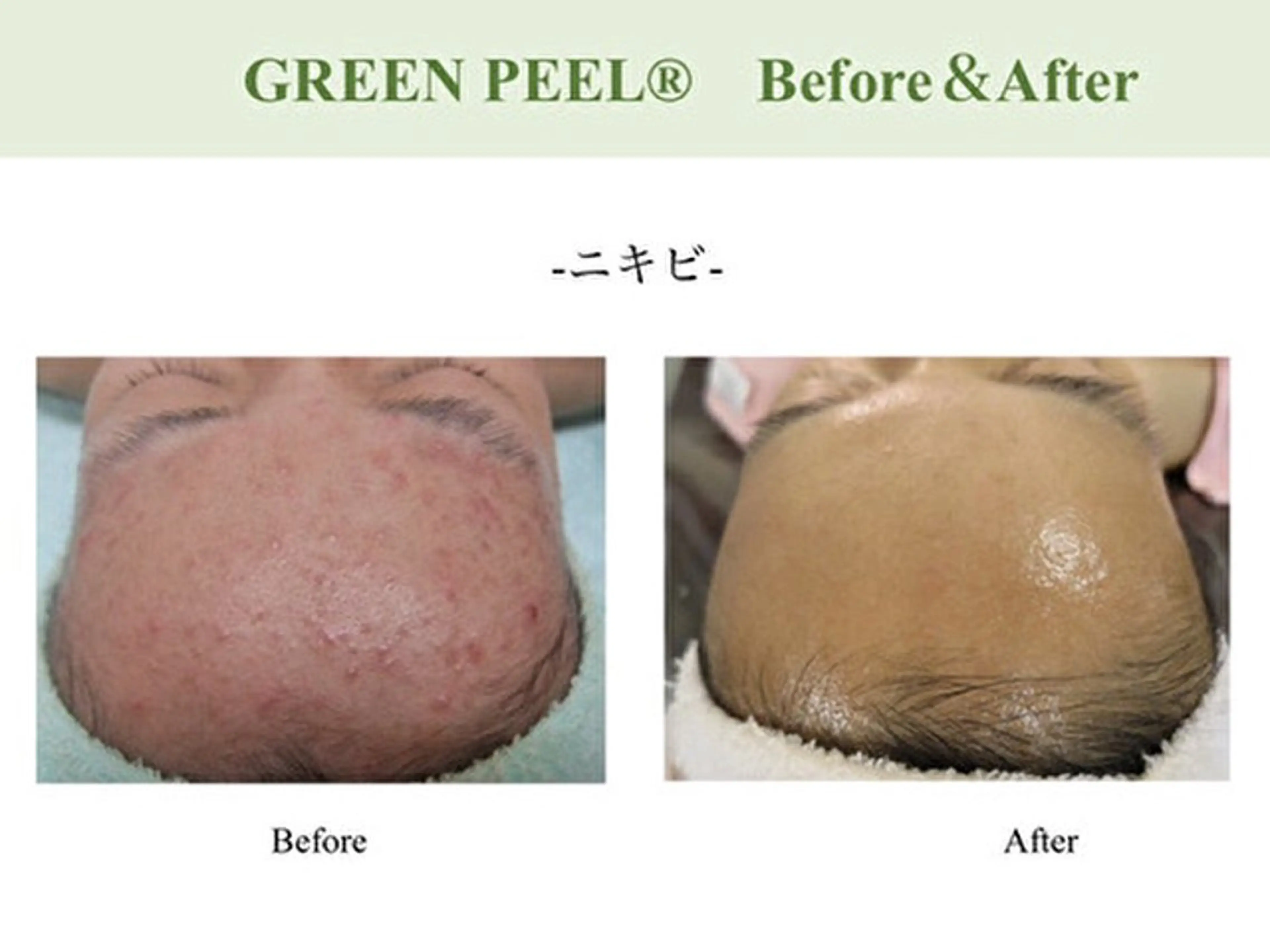 世界中で大人気グリーンピールの写真