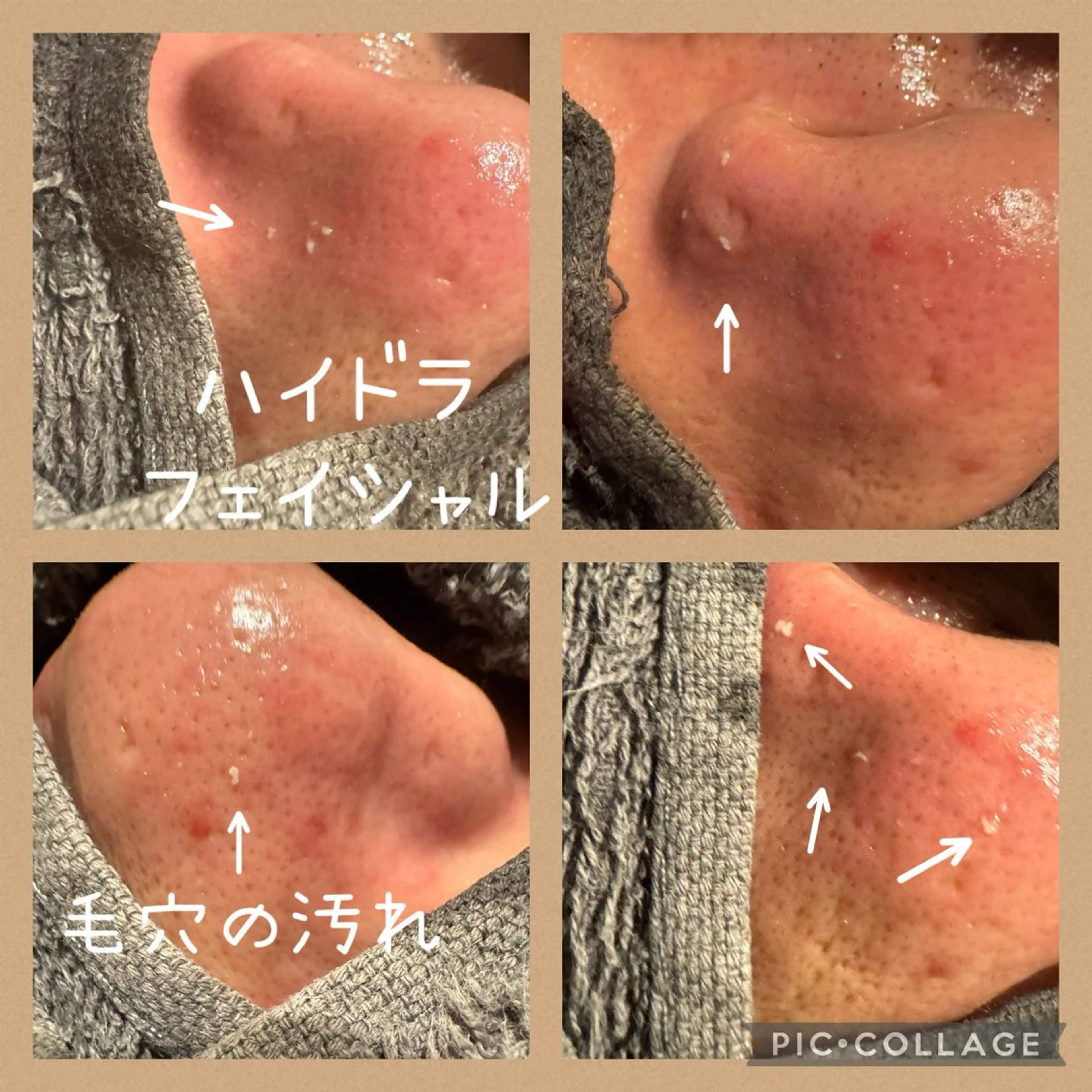 ニキビ撃退、専用液使用し毛穴洗浄+美容液浸透（毛穴の汚れに最適）の写真