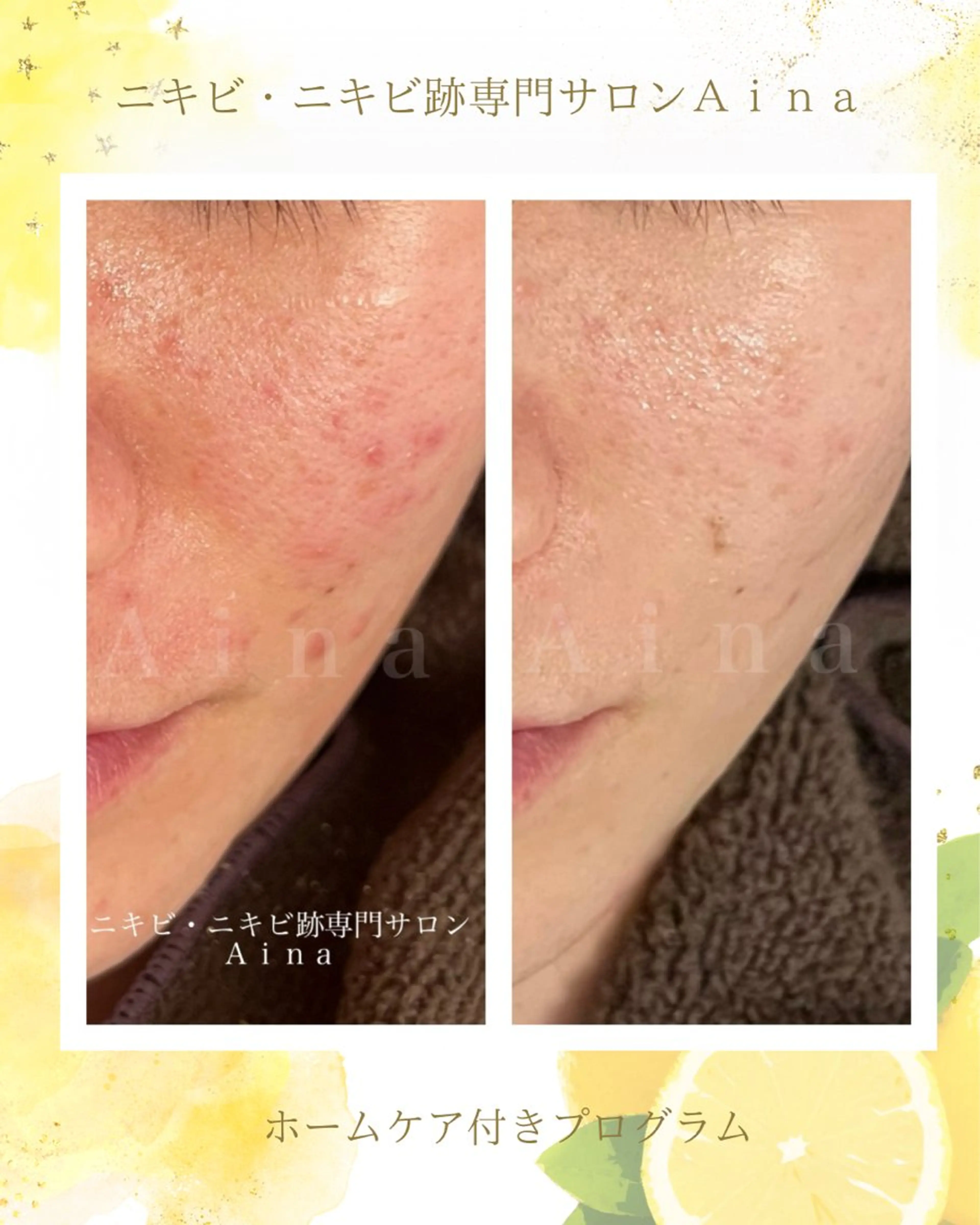 ニキビ跡専門サロン Ａｉｎａのエステ・リラクイメージ