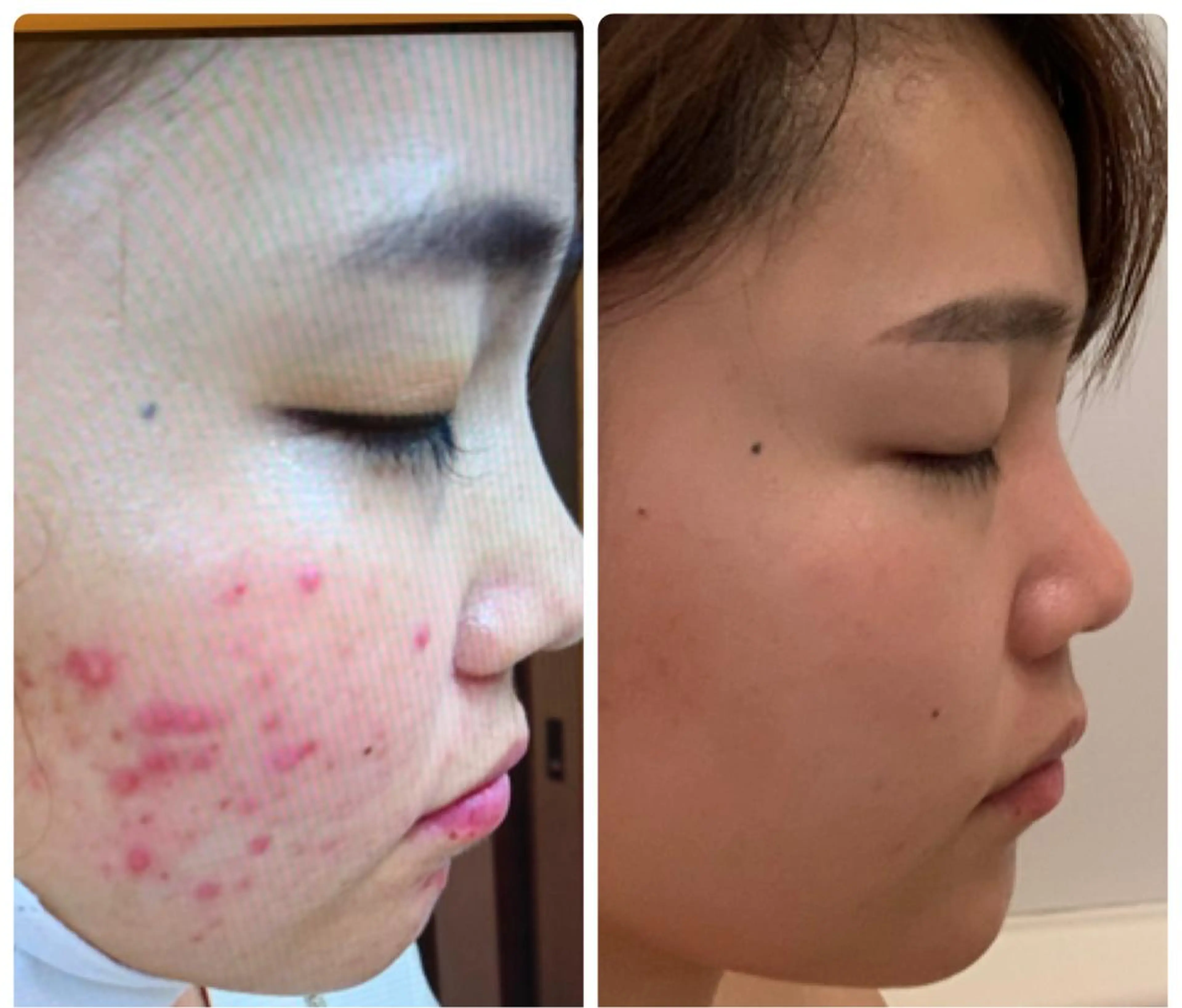 フェイシャルイオン導入の写真