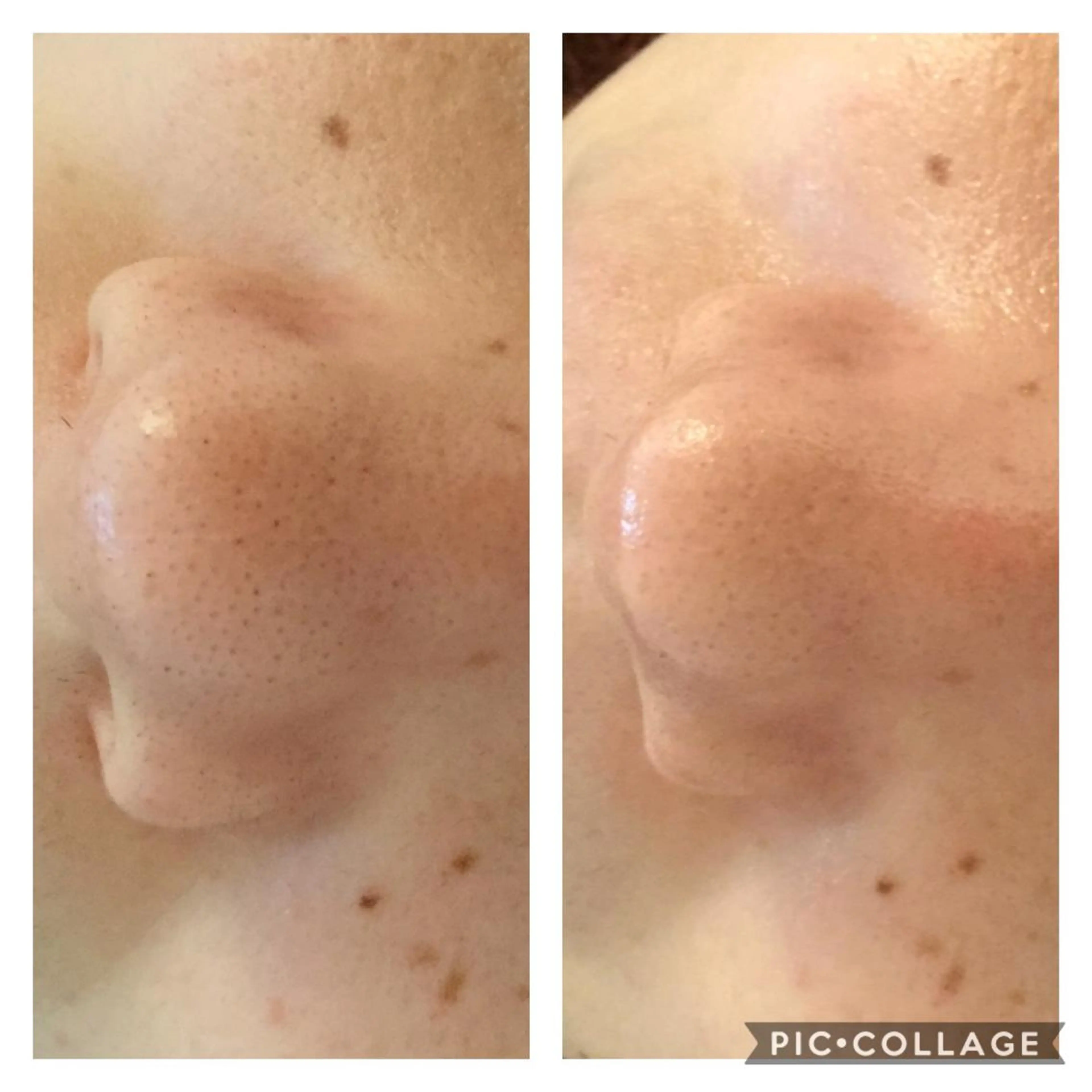 エステ リラク ニキビ/肌質改善専門 Snow skinのエステ・リラクイメージ