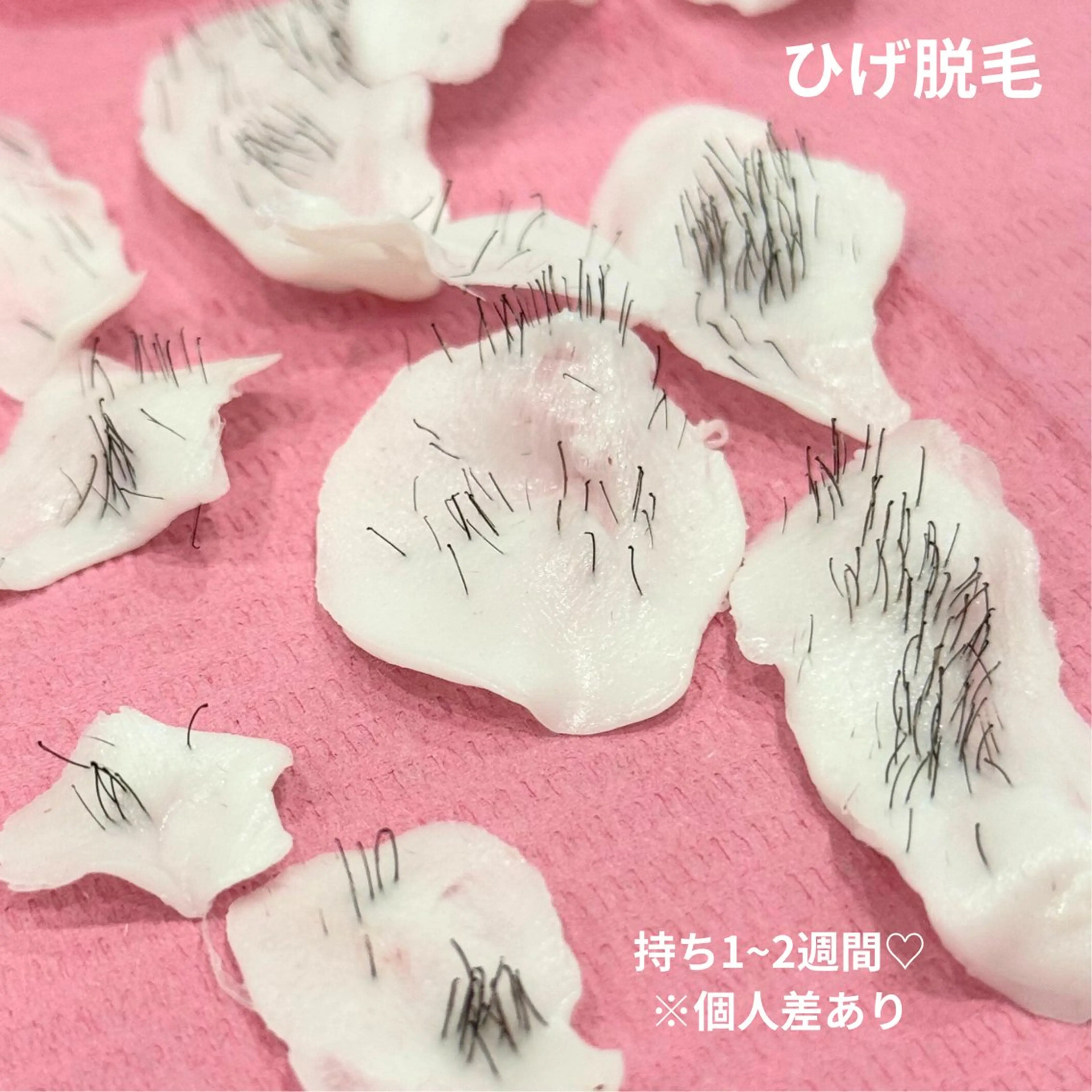 男性ひげwax脱毛の写真