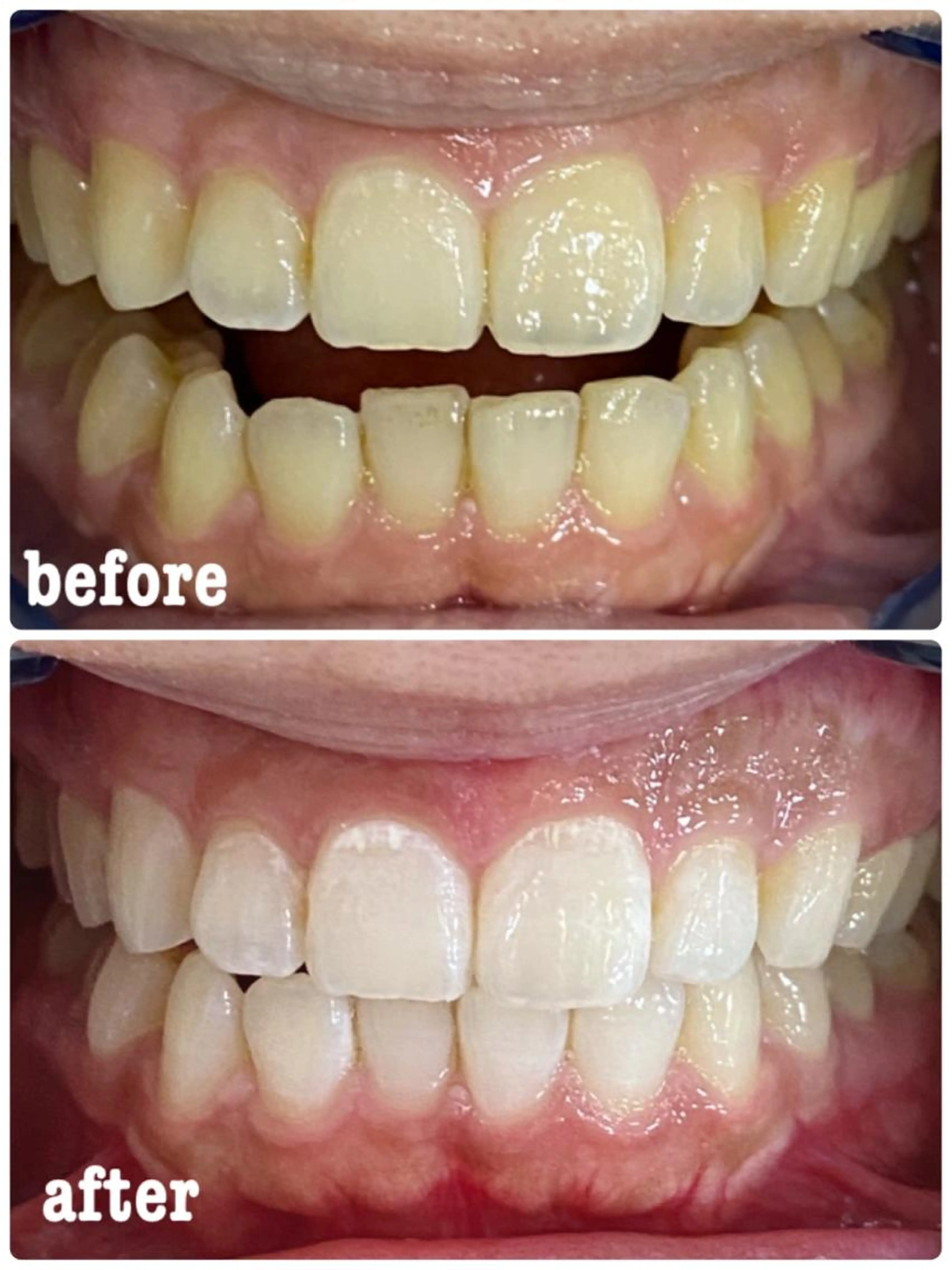 2枠のみ！4/16まで🔥2年間通い放題チケット！！最大3名様まで同じチケットで通えます⭕️セルフホワイトニング🦷の写真