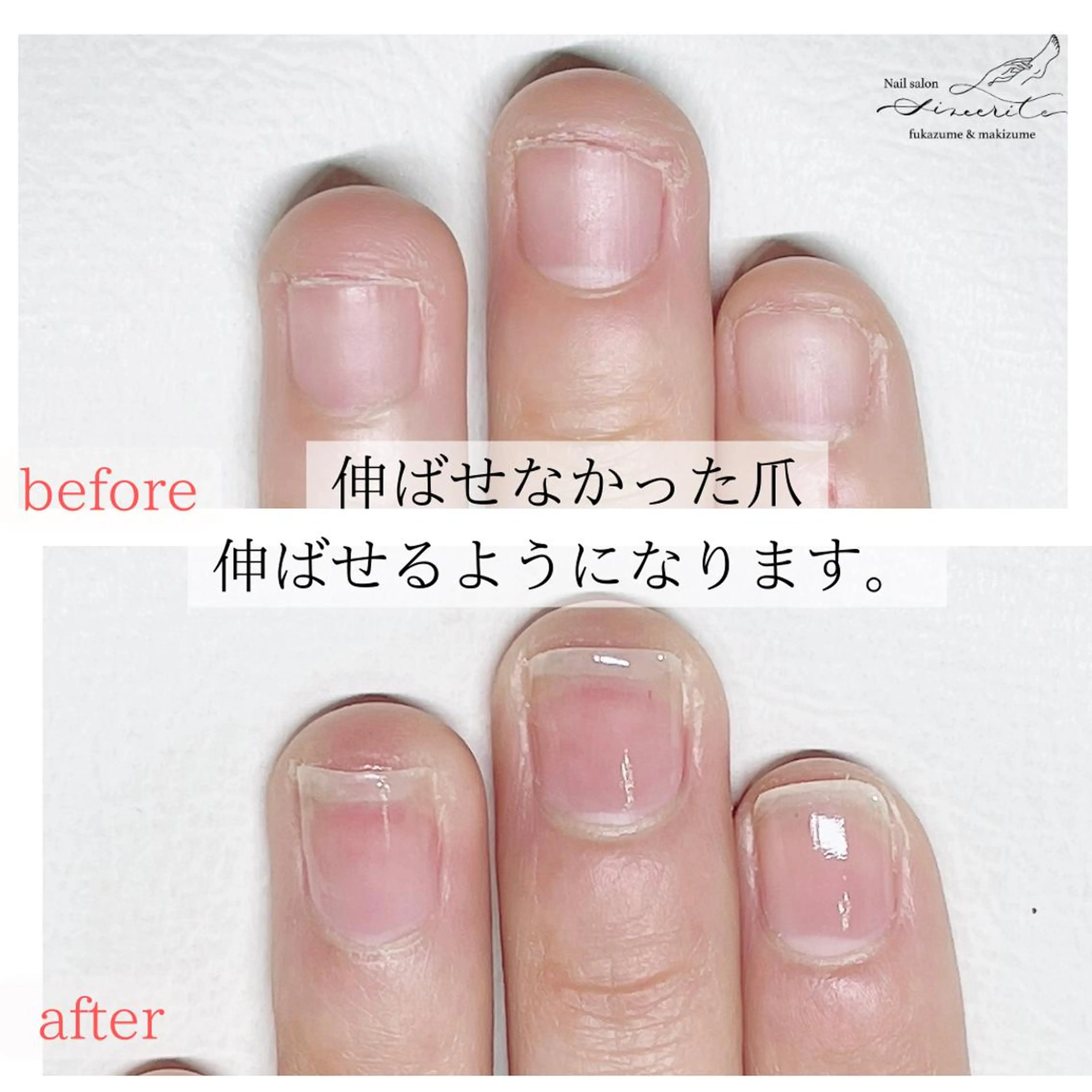 ネイル ネイルチップ 深爪・巻き爪 専門サンセリテのネイルデザイン