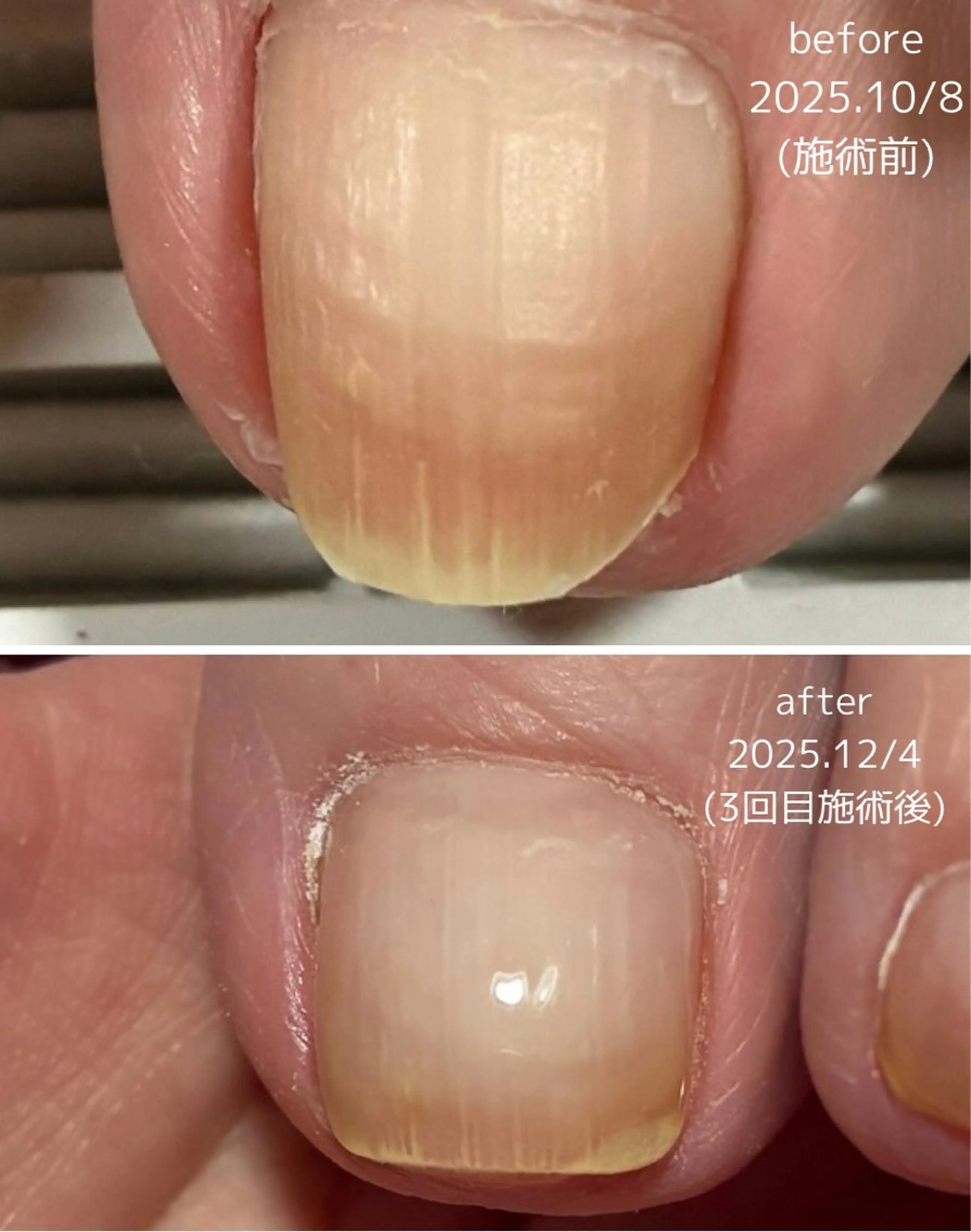 ネイル クリアネイル フットネイル マグネットネイル ワンカラーネイル Li.m nail リム ネイルのネイルデザイン