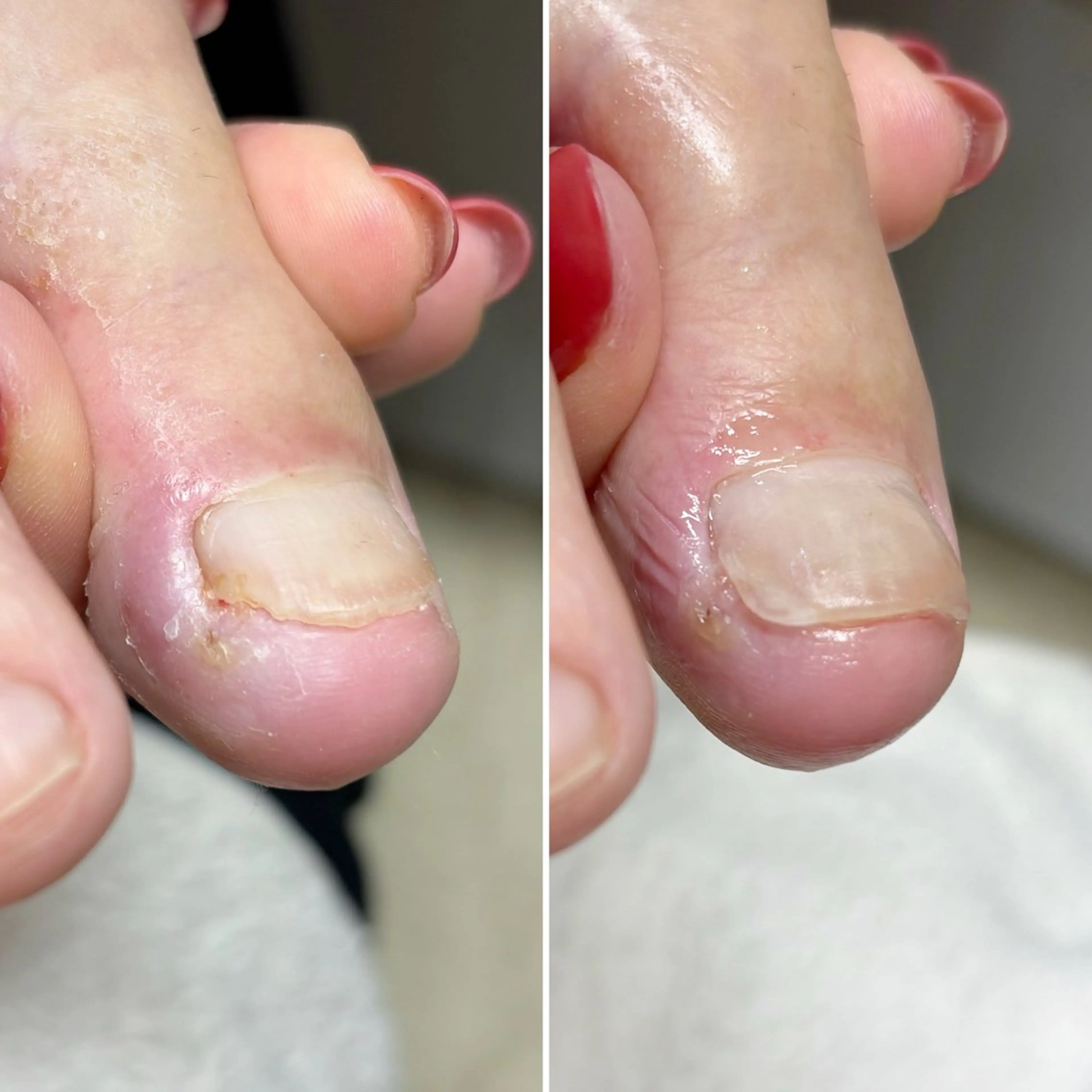 ネイル 赤色 深爪・巻き爪 専門サンセリテのネイルデザイン