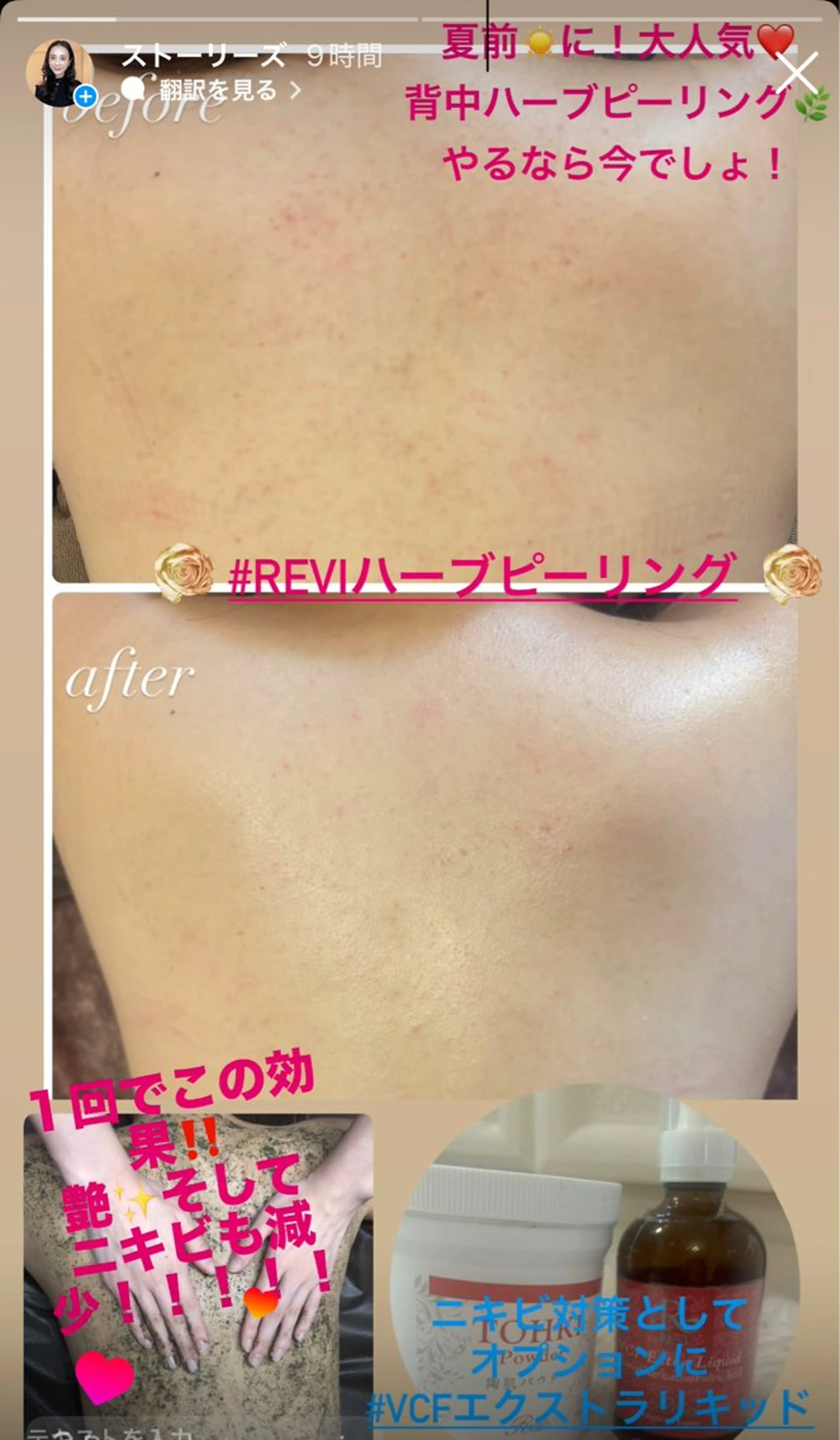 ハーブピーリング専門 毛穴洗浄❤️眉waxのエステ・リラクイメージ