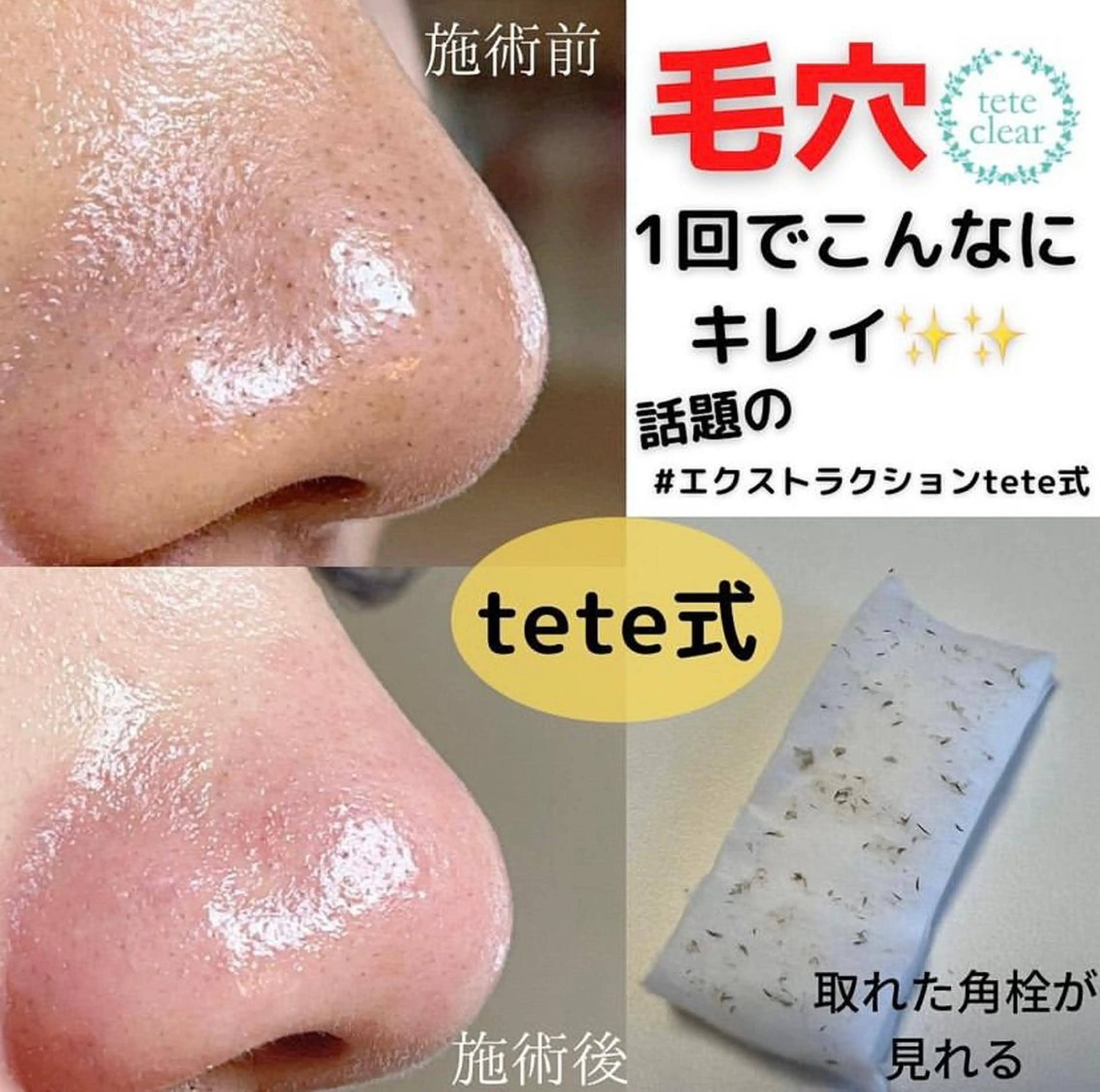 【2.3月限定】毛穴スッキリトリートメント🫧の写真