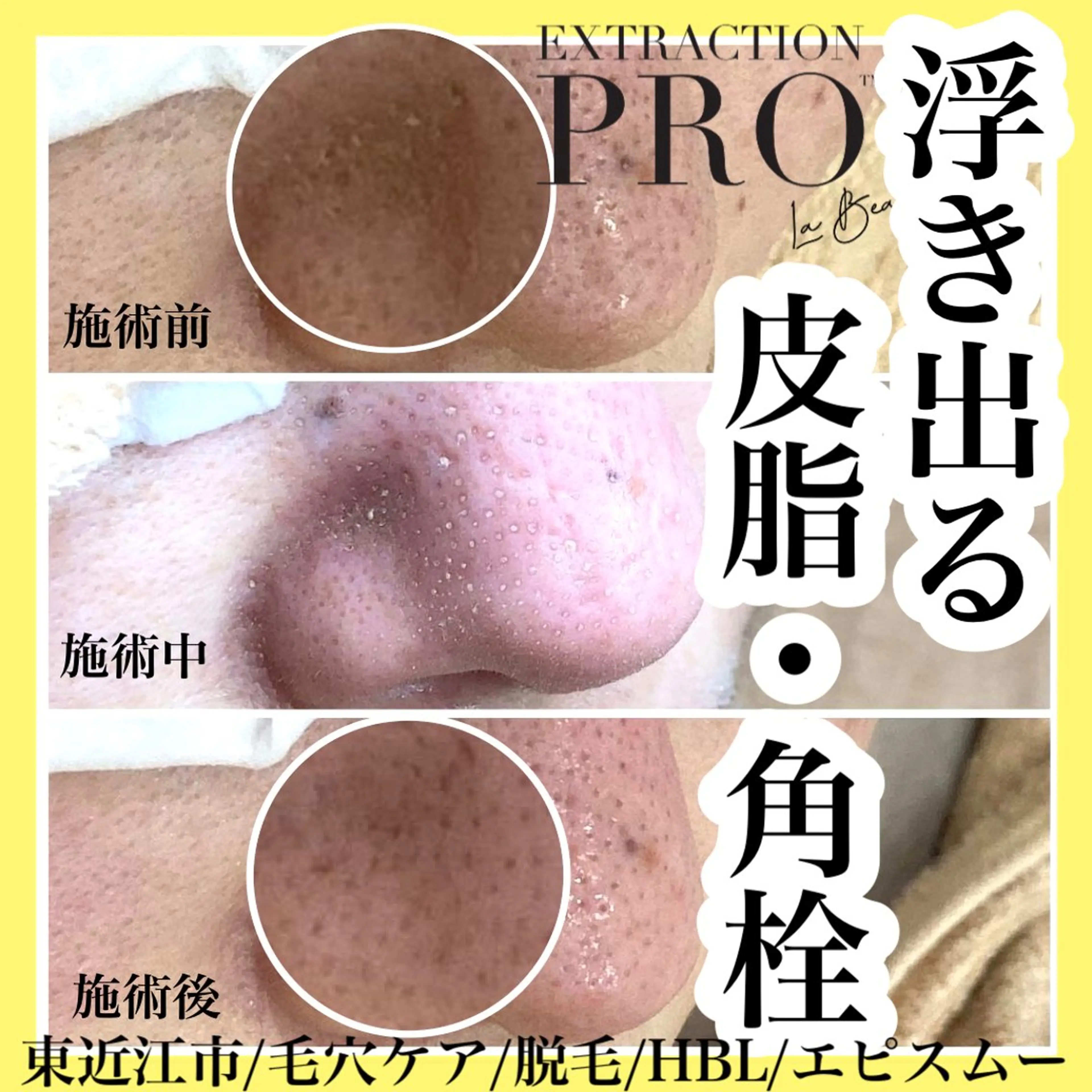 epismoo 脱毛/HBL/毛穴の眉毛・アイブロウイメージ