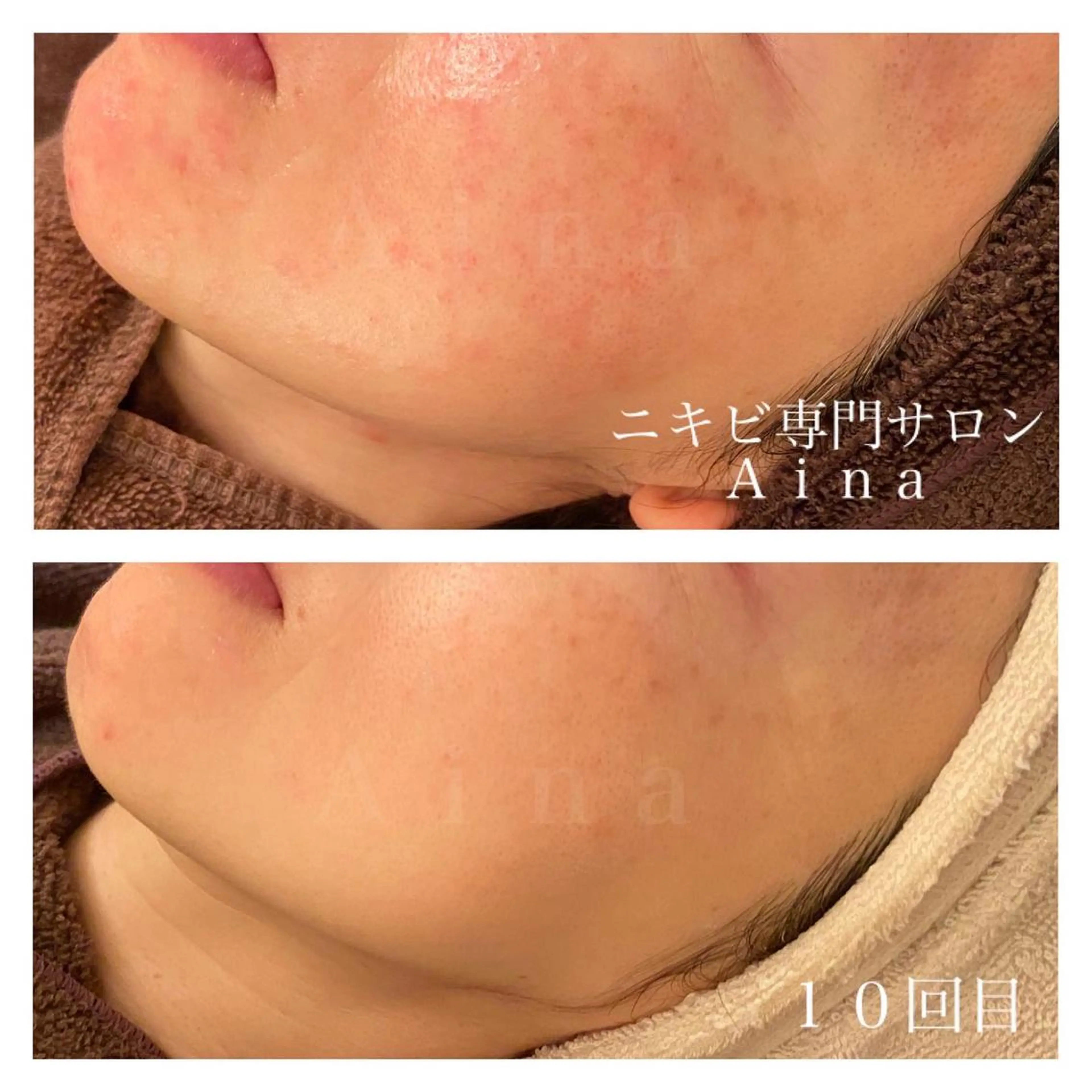 セミロング カラー パーマ ヘアアレンジ メンズ キッズ ネイル マツエク・マツパ エステ リラク ニキビ跡専門サロン Ａｉｎａのエステ・リラクイメージ