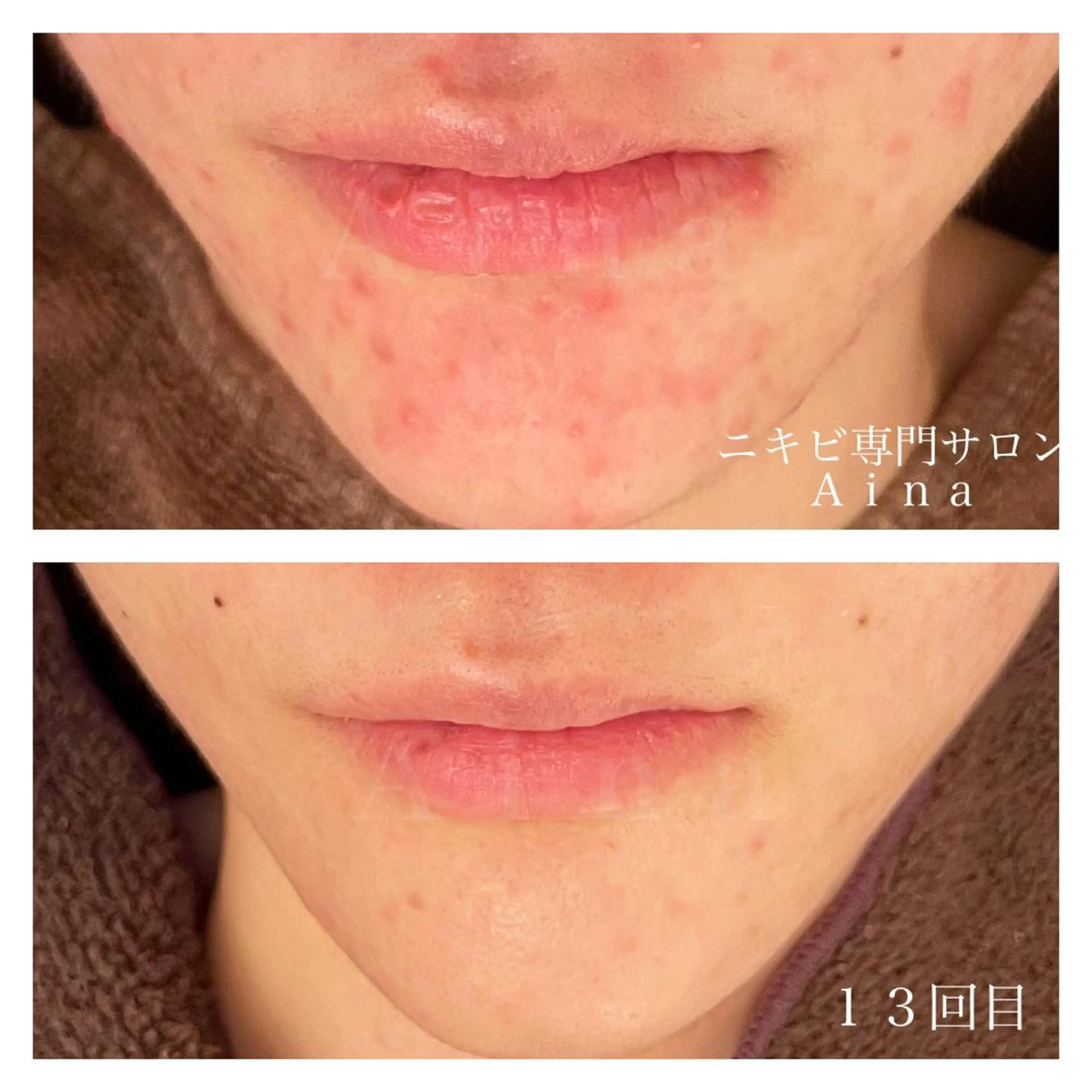 セミロング カラー パーマ ヘアアレンジ メンズ キッズ ネイル マツエク・マツパ アイブロウ ニキビ跡専門サロン Ａｉｎａのエステ・リラクイメージ