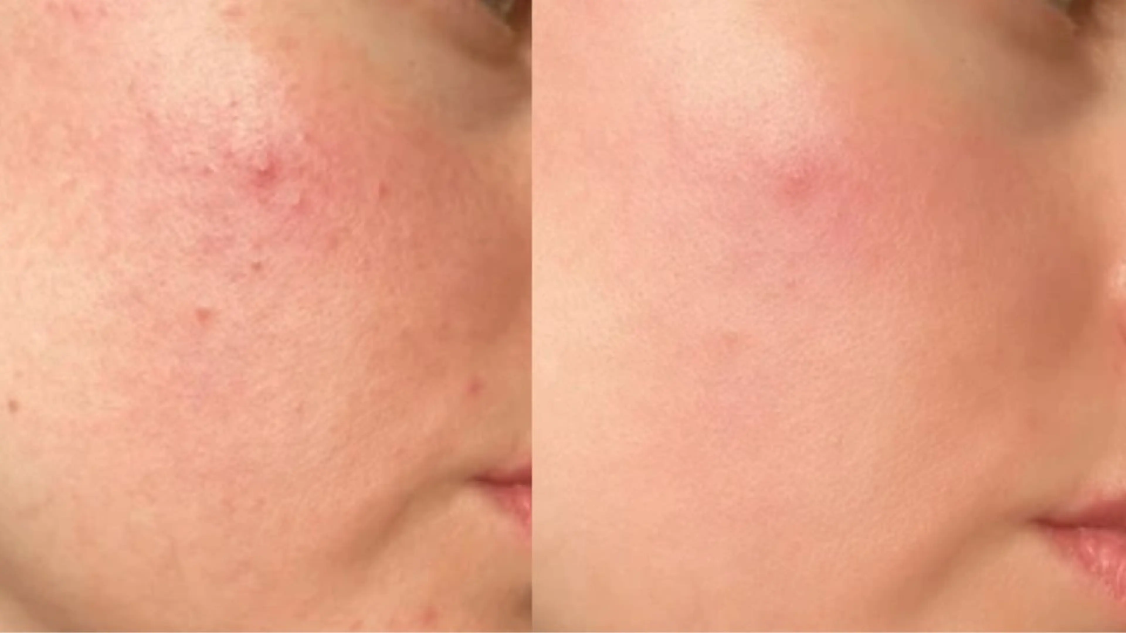 【初回限定！】ザラつき/ニキビケア　​〜​当サロンご新規様限定​〜​フェイシャルエステの写真