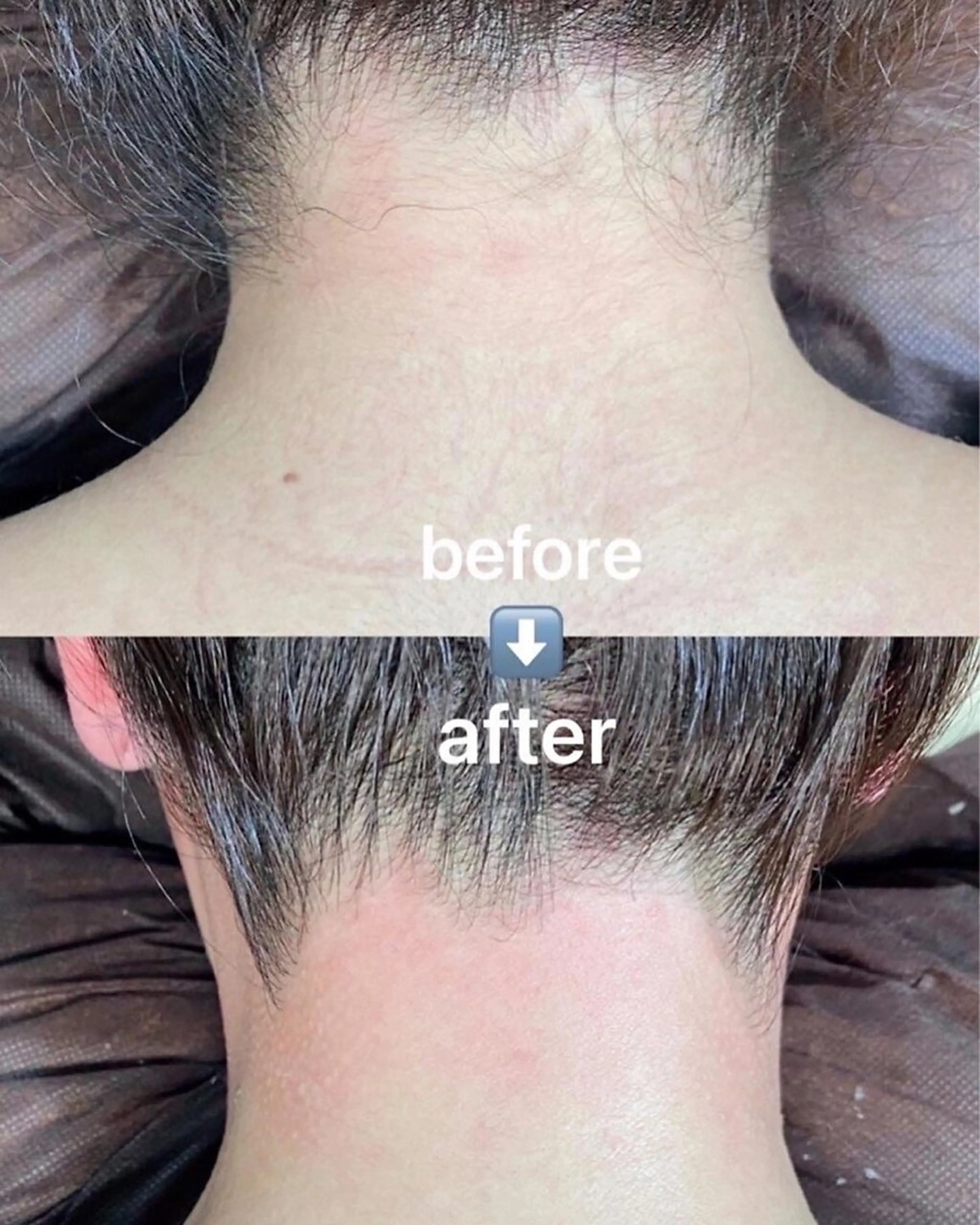 【女性限定】(無料シェービング付き)うなじ～背中光脱毛の写真