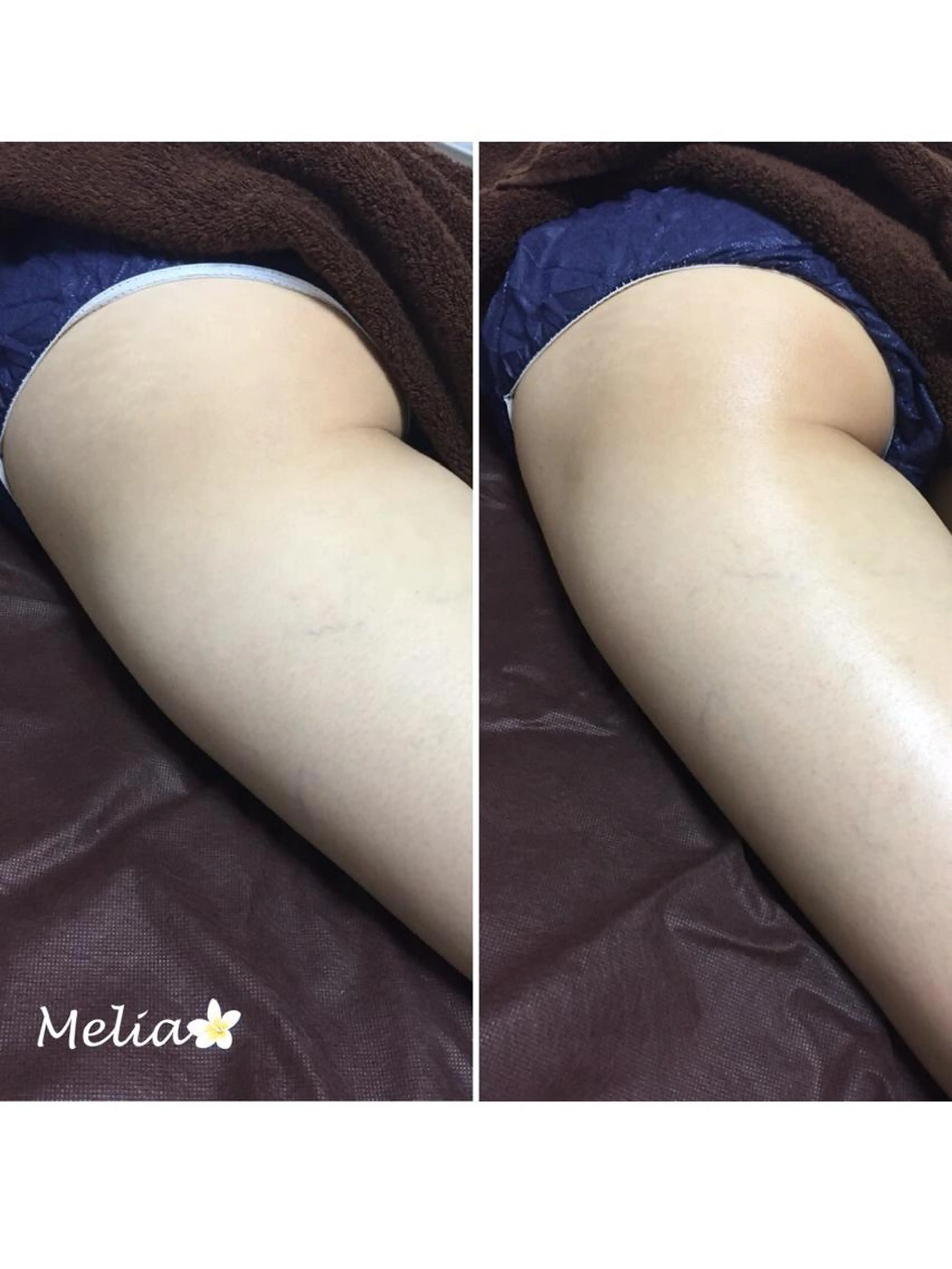 【リンパ痩身】美脚、ウエスト引き締め、ヒップアップ、冷え性の方にオススメ！お試し60分コース 11000円→6600円の写真