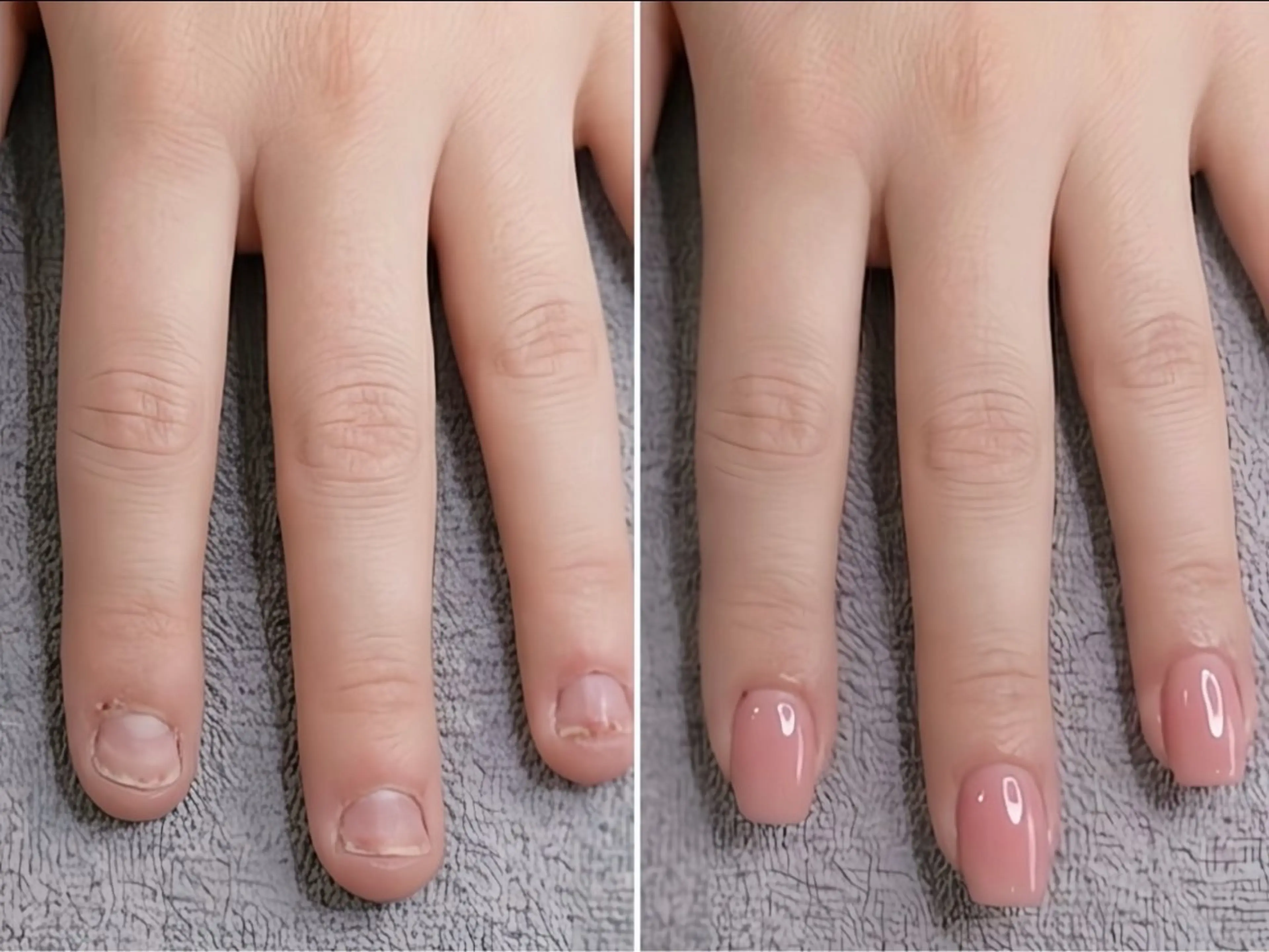 【3名限定】深爪矯正3ヶ月集中コース✨プロの技術で「爪の悩み」を卒業！完全無料モニター募集💅の写真