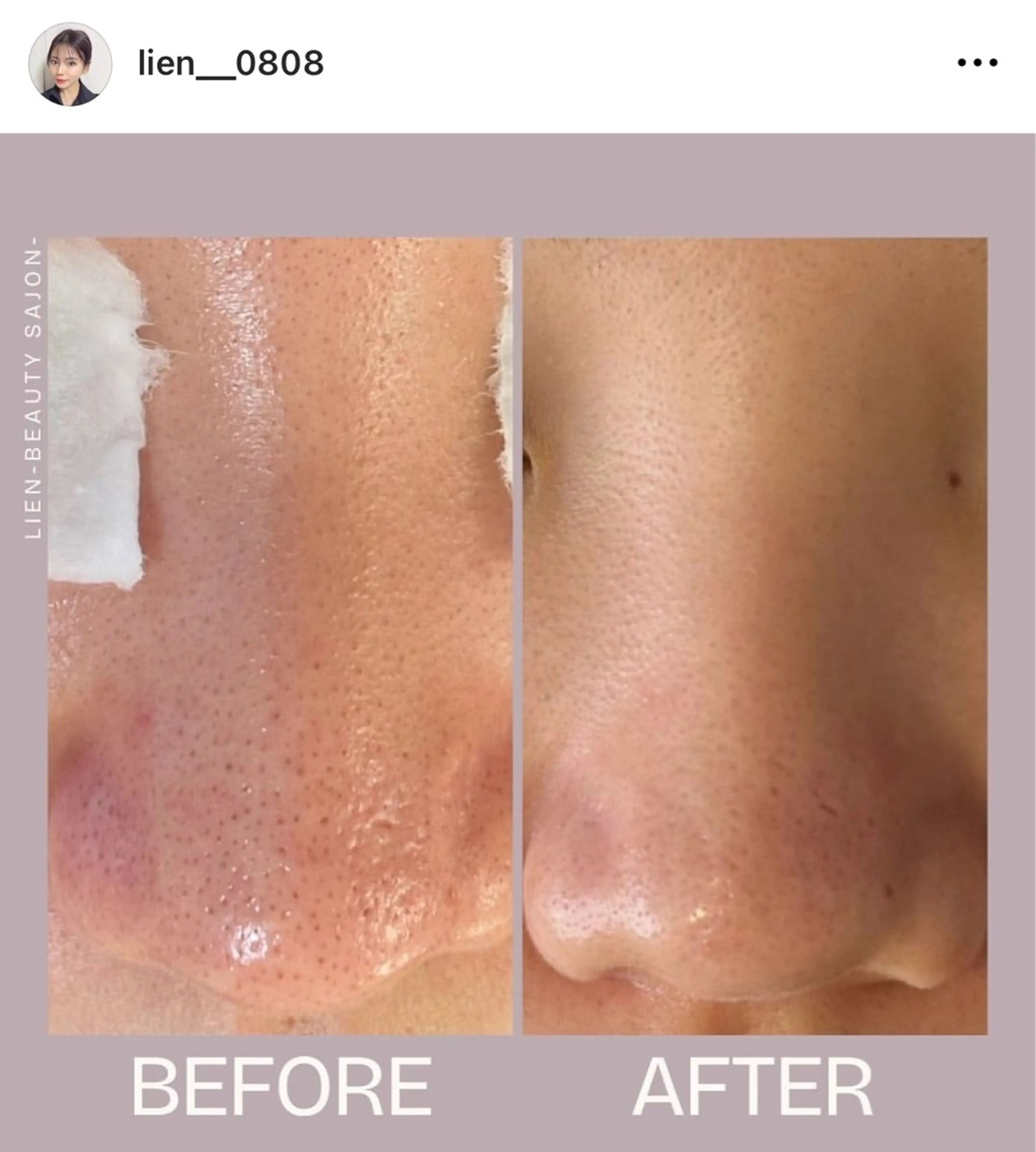 【初回毛穴ピーリング付】ハイドロfacial！黒ずみ/くすみ/ごわつき/テカリの写真