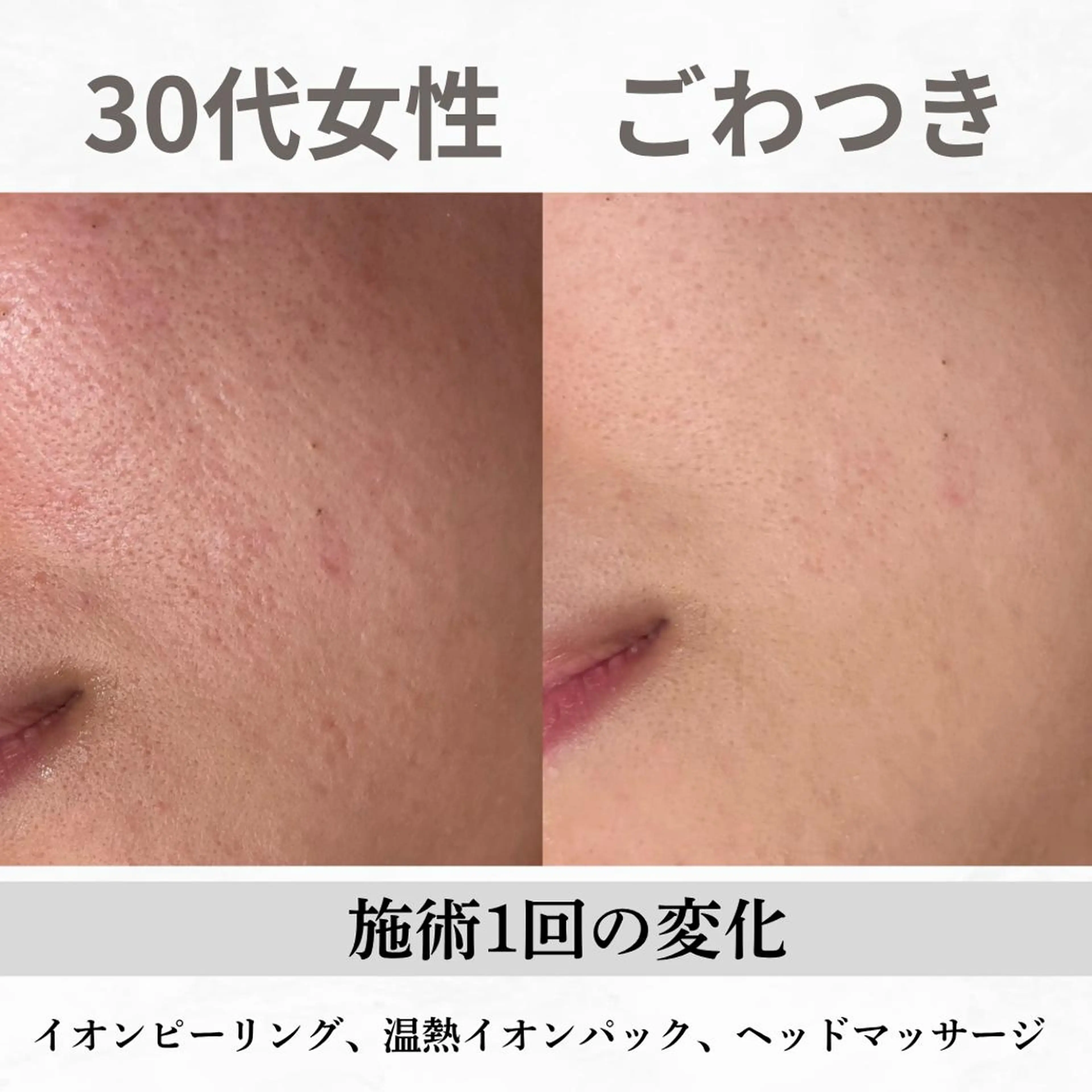 重度ニキビ専門🌷 ダウンタイムなしのエステ・リラクイメージ