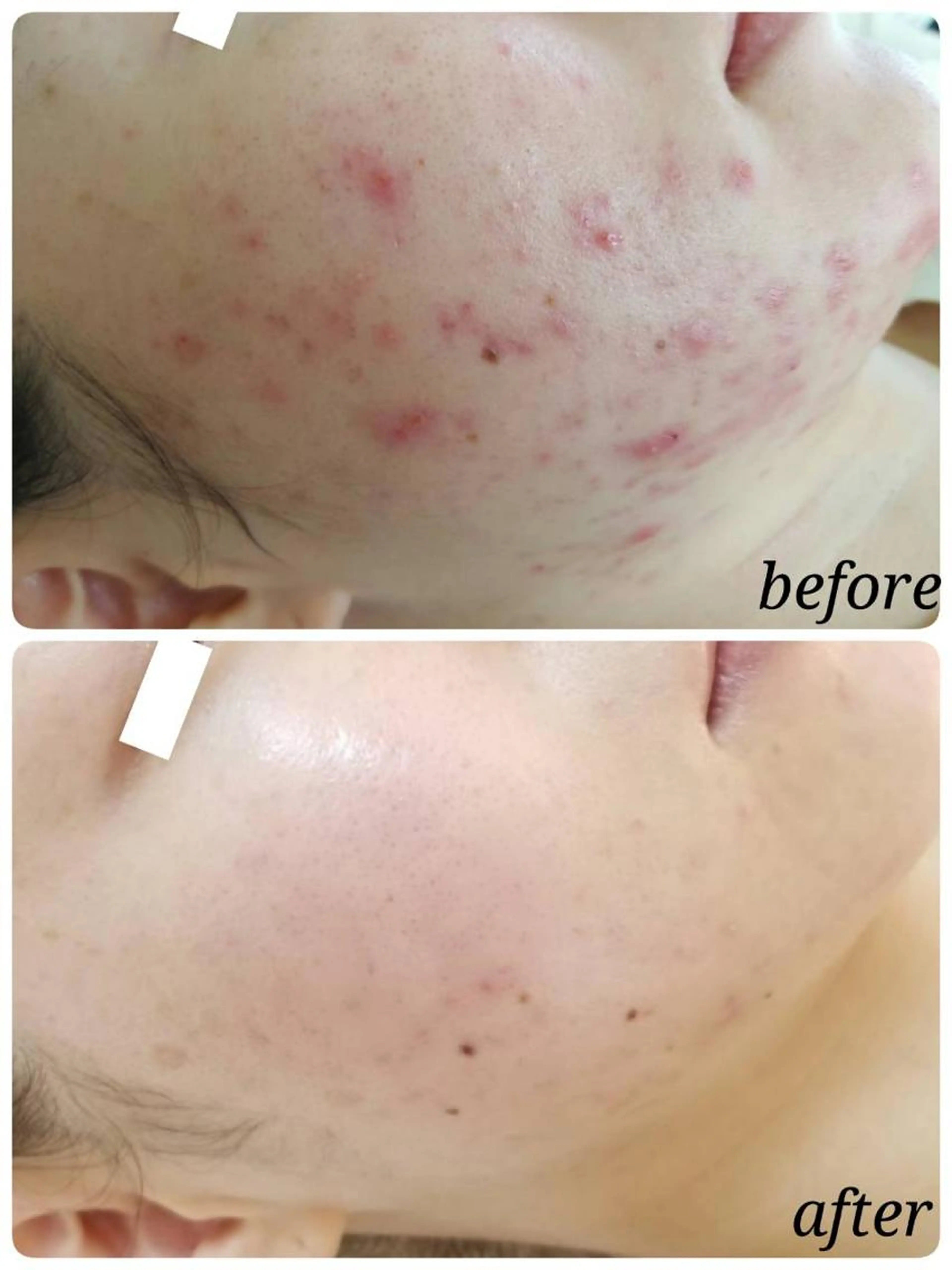 \ニキビ・毛穴に特化/!!次世代ハーブピーリング!!剥離もなくてつづけやすい!の写真