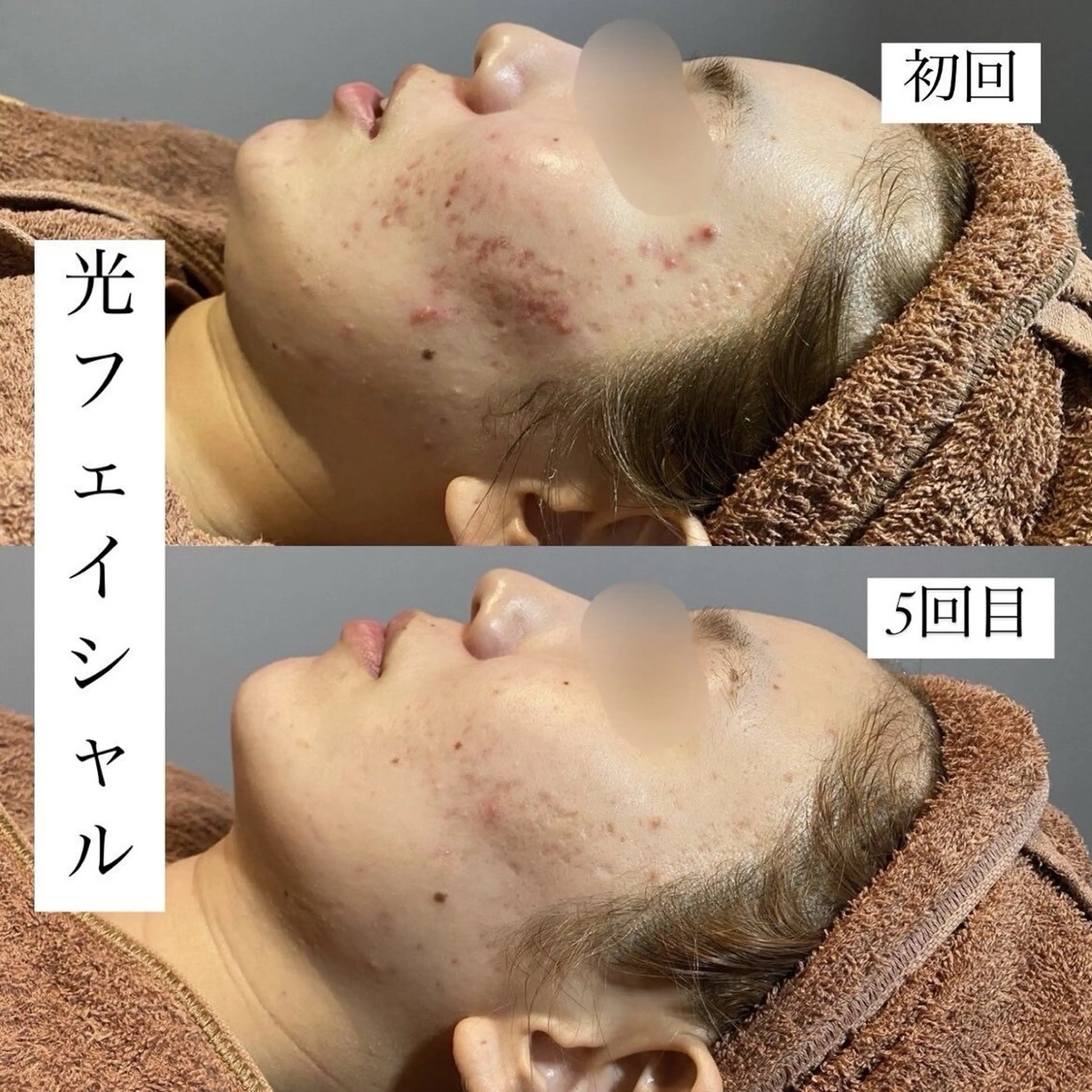 emiluca西目/ 脱毛/細胞美容のエステ・リラクイメージ