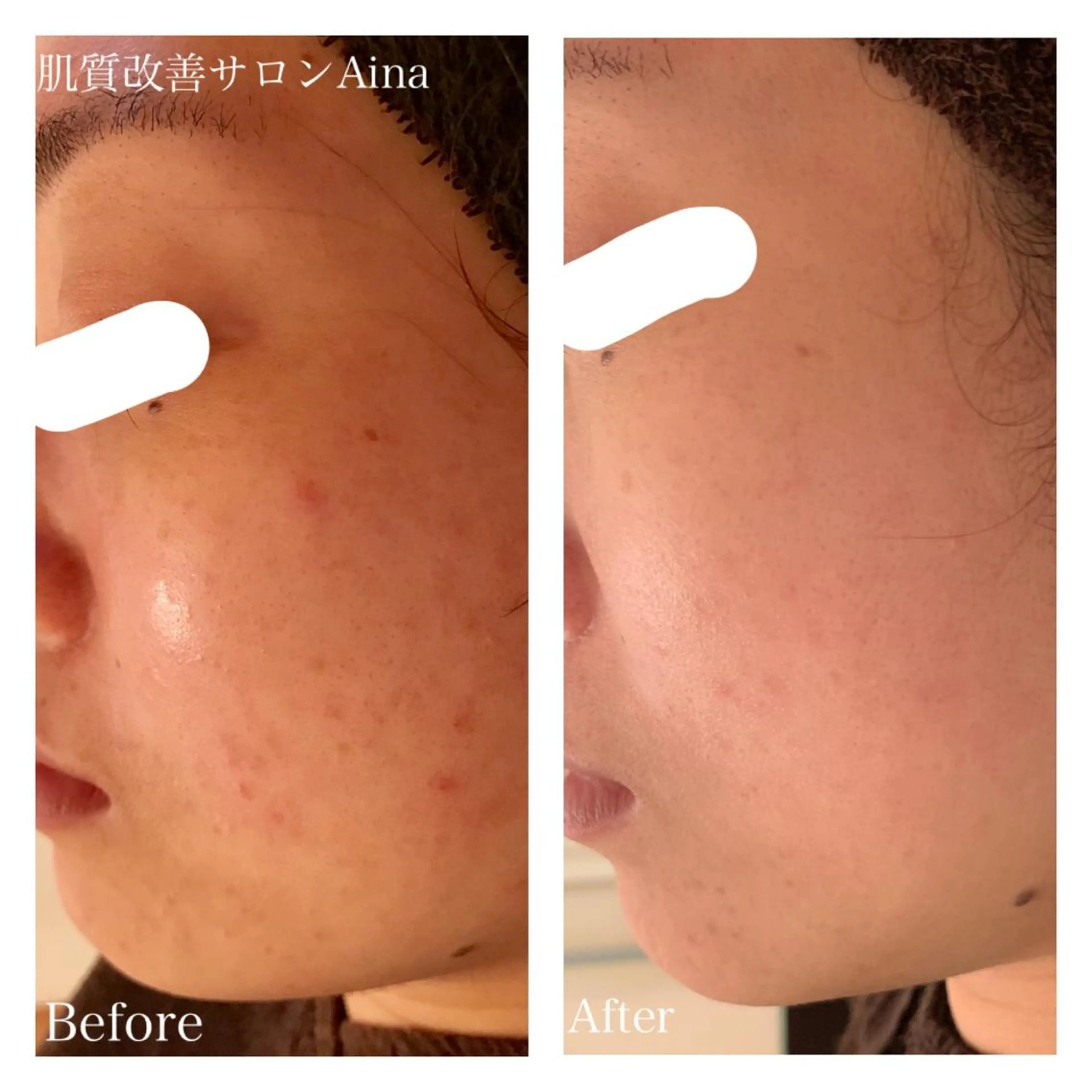 ミディアム パーマ キッズ ネイル マツエク・マツパ エステ リラク ニキビ跡専門サロン Ainaのエステ・リラクイメージ