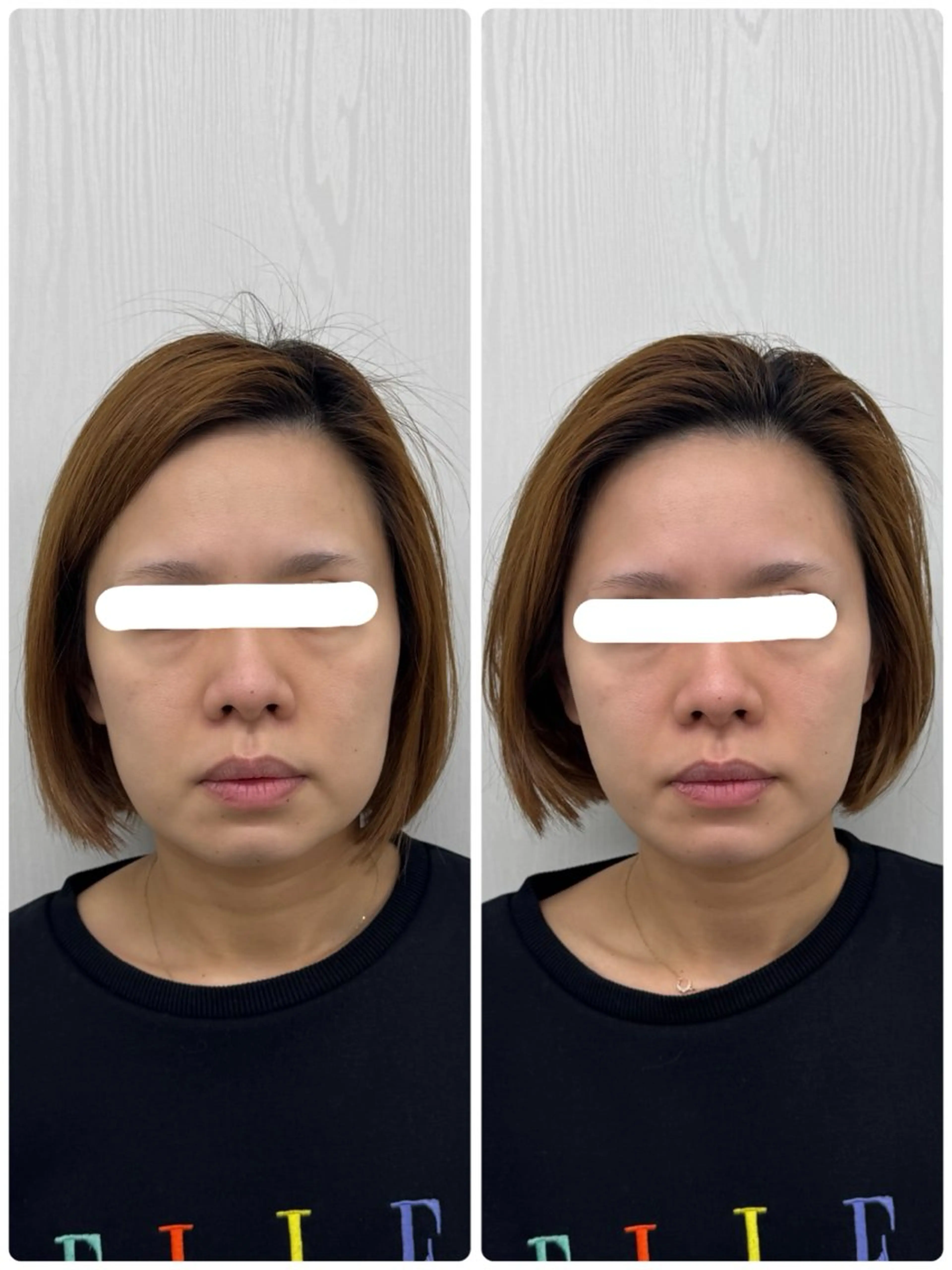 エステ 美容鍼×小顔矯正 ×美容整体　浜川泰仁のエステ・リラクイメージ