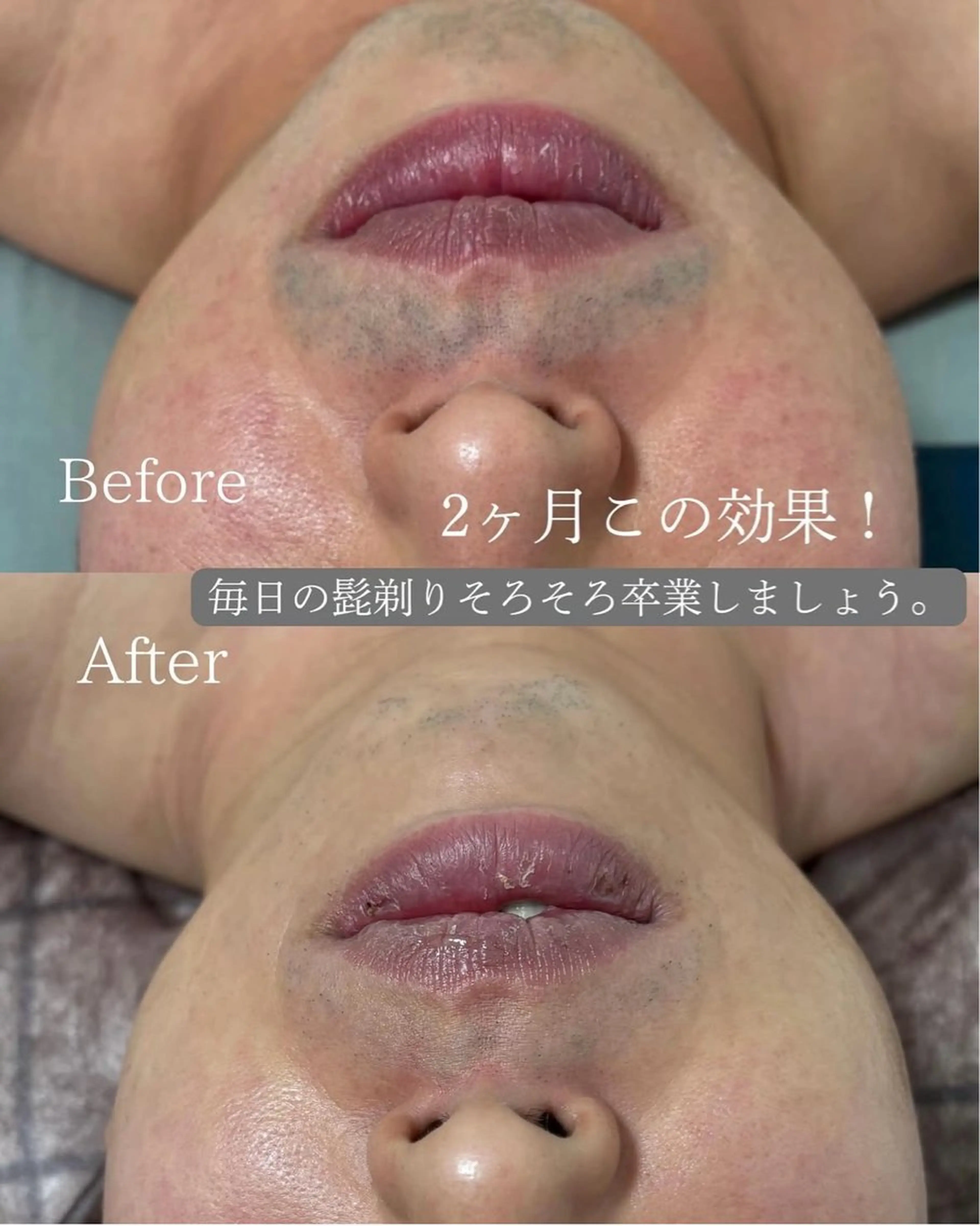 ✨1番人気✨【🔥圧倒的効果🔥】初回全身脱毛7,500円🦷✨の写真