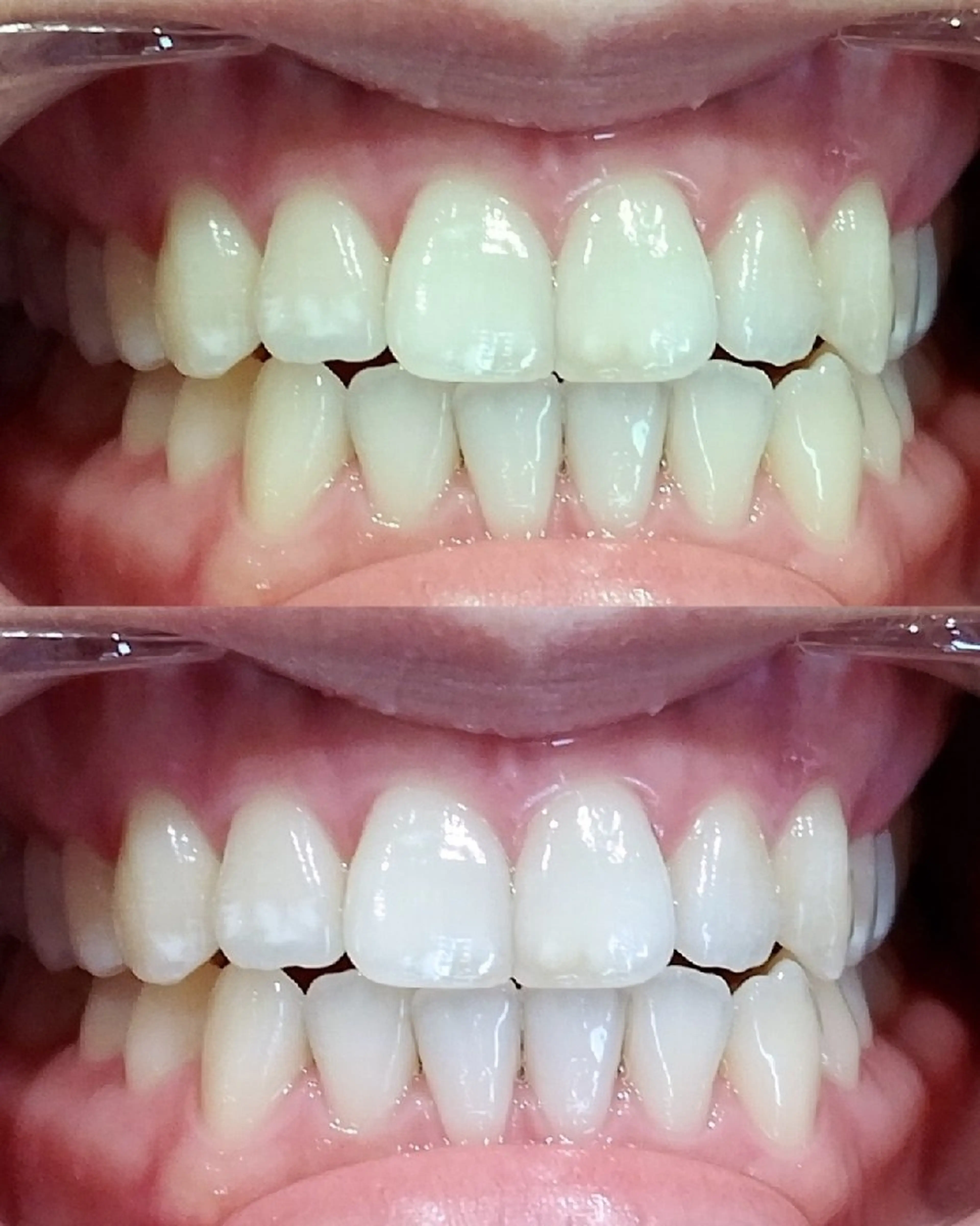 【ミニモ学割】１５歳以上の学生セルフホワイトニング８分照射×２回の写真