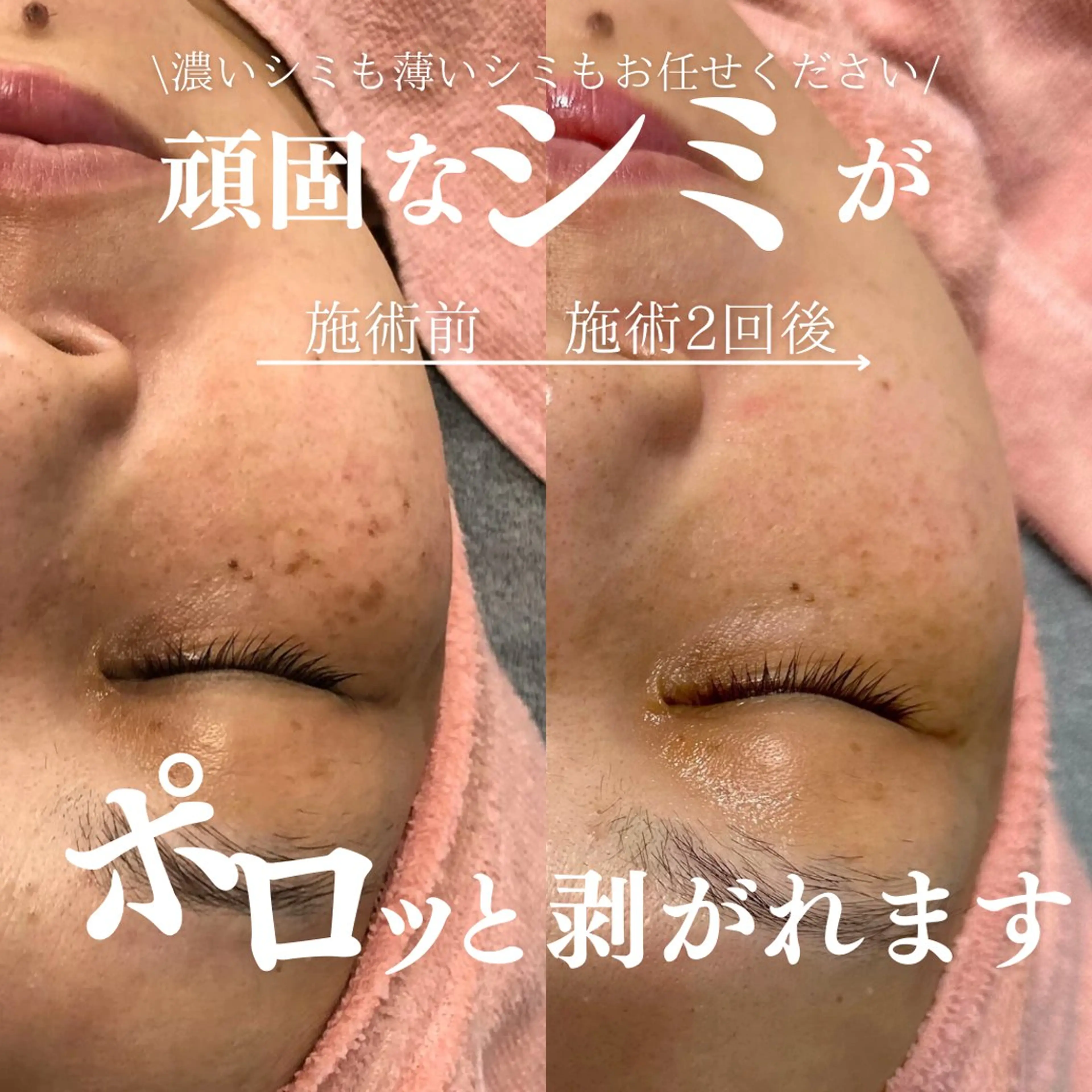 ✨シミ取り放題20分✨《シミケアコース》お肌に優しい低周波シミ取りで1週間でシミをポロッと剥離◎の写真