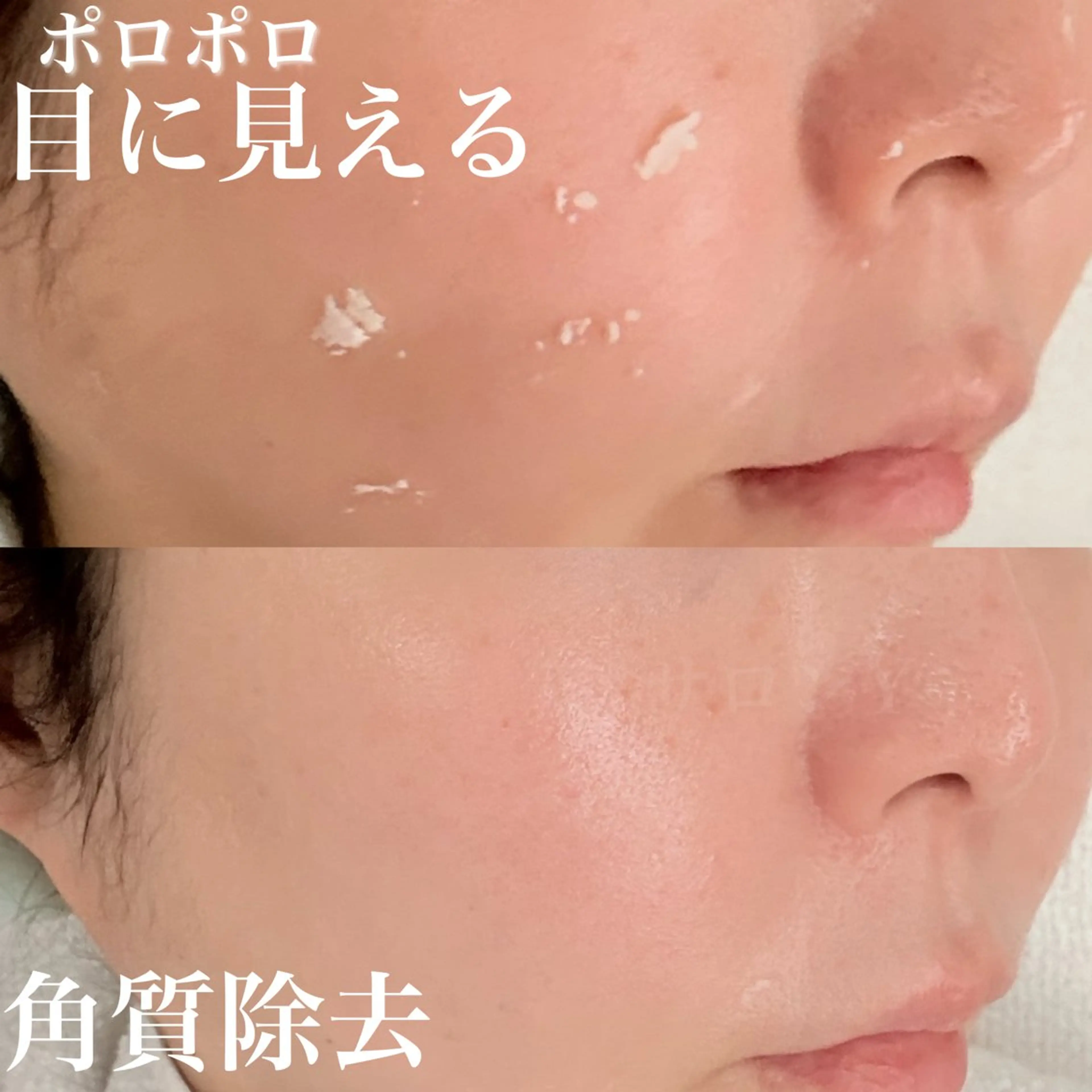 3月限定40%OFF★酵素ピーリング角質ポロポロ★天然由来成分でダウンタイムなし！の写真