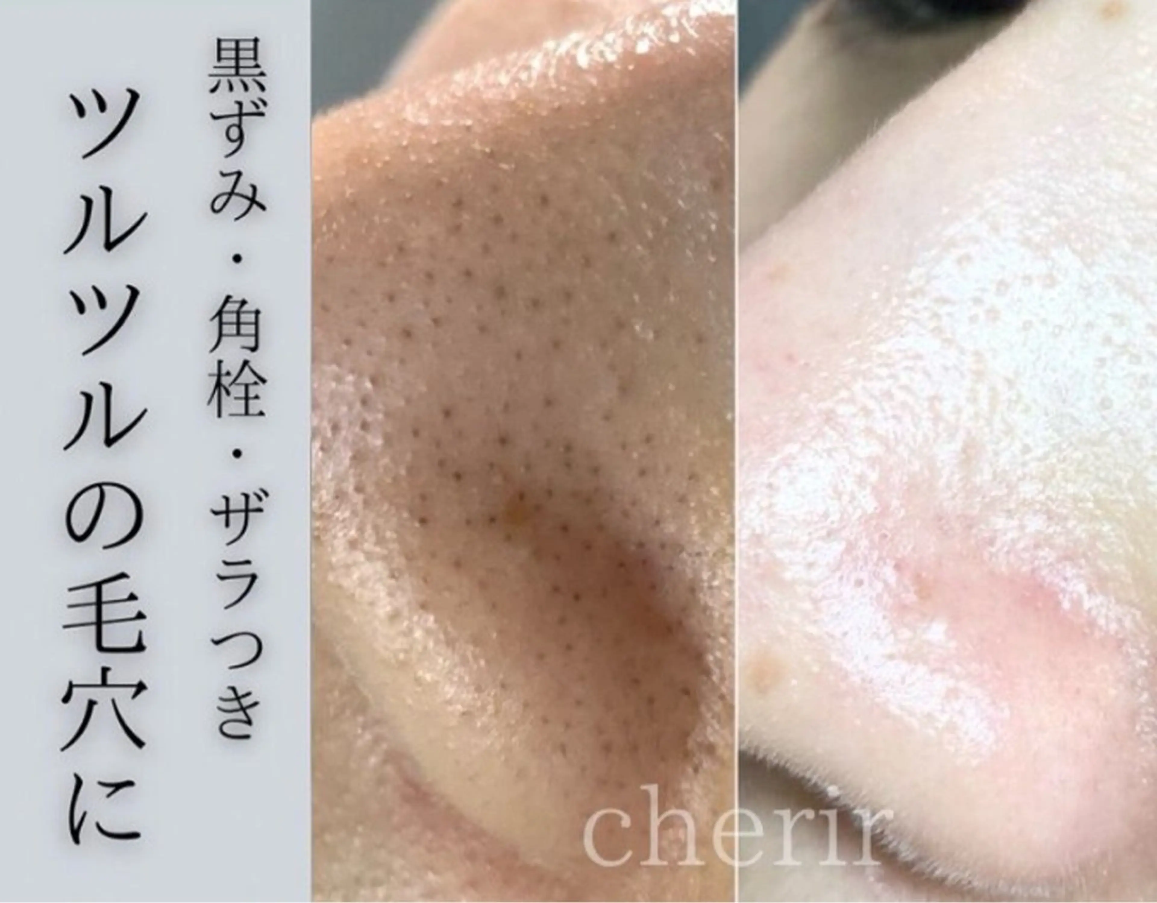 【ダブル毛穴洗浄】毛穴エクストラクション＋ハイドラ毛穴洗浄🫧毛穴黒ずみ＆詰まり改善◎の写真