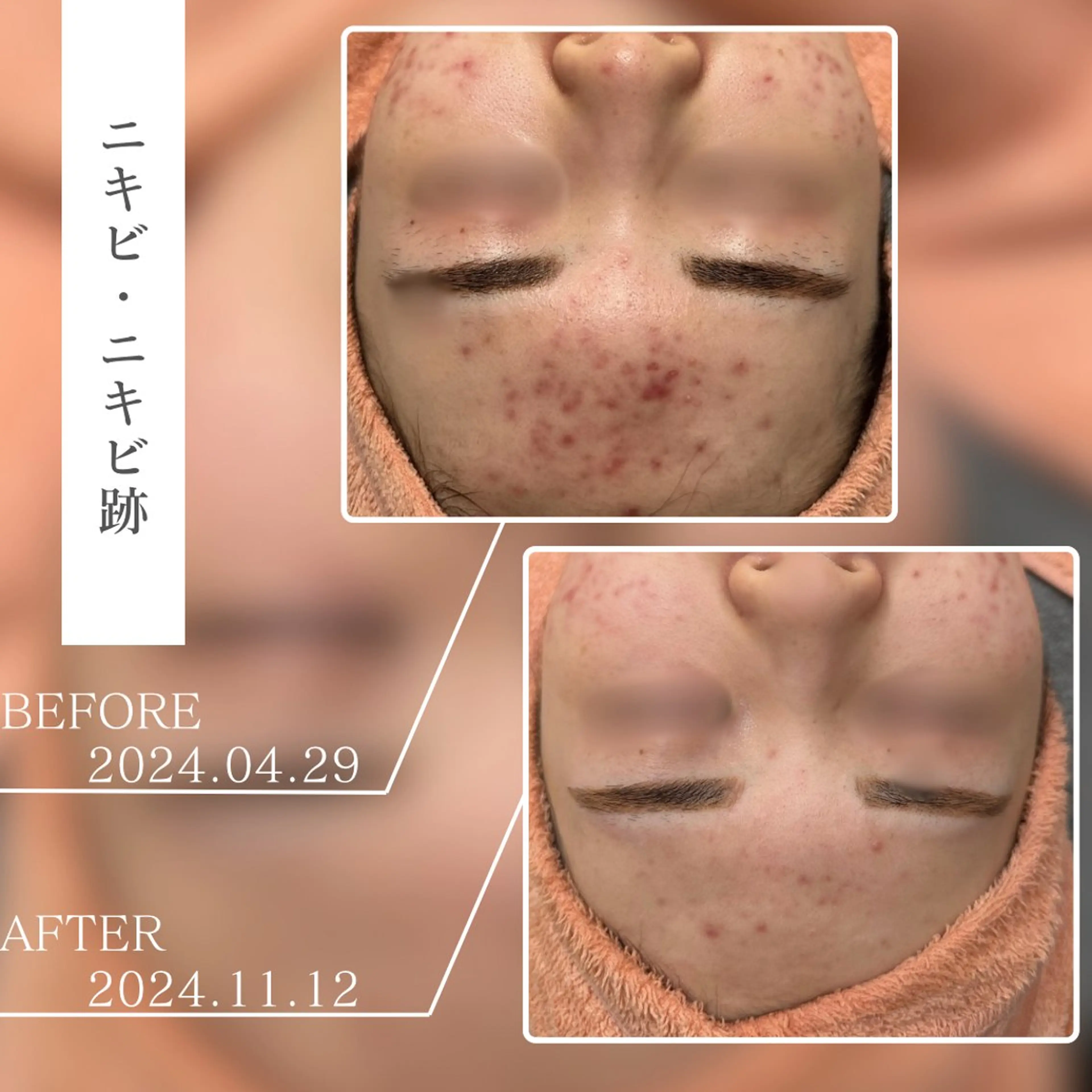 キッズ BestBelleꕤ 大阪福島/肌質改善のエステ・リラクイメージ