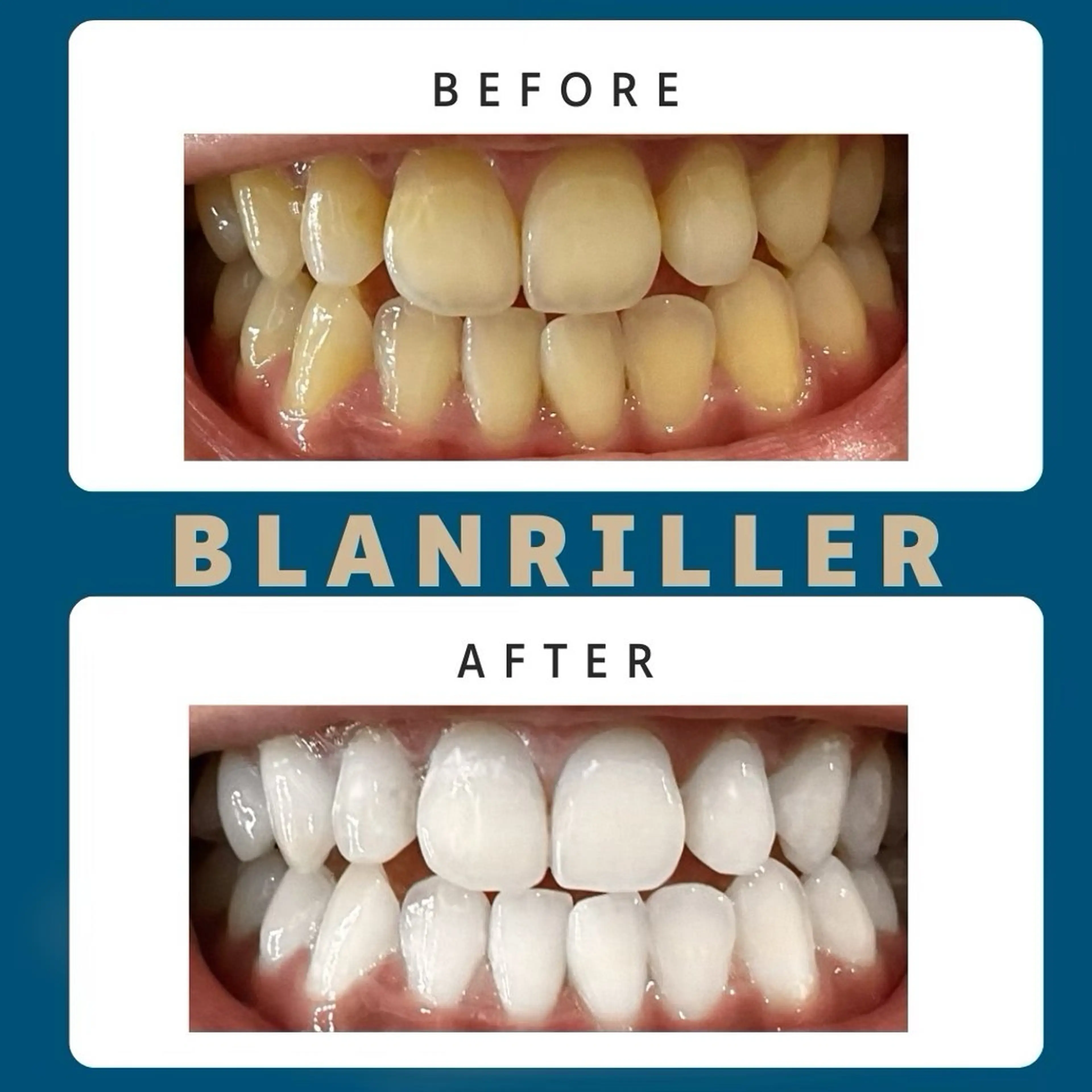 【10回*回数券】セルフホワイトニング15分×2回 10日分 通常¥50000→¥35000の写真