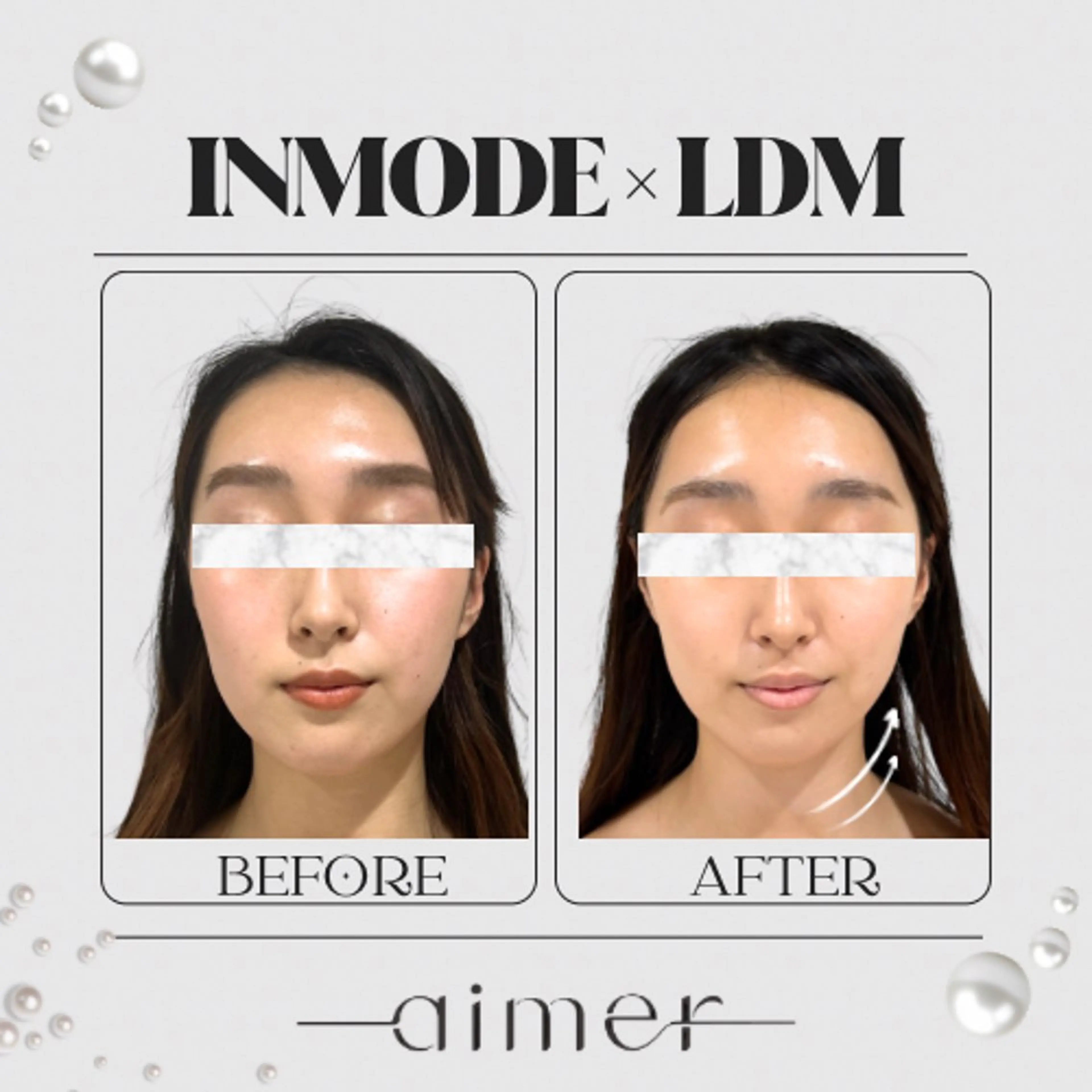 《ミニモ学割》U24❣️  小顔Vライン生成◆インモード×LDM水玉リフティングの写真