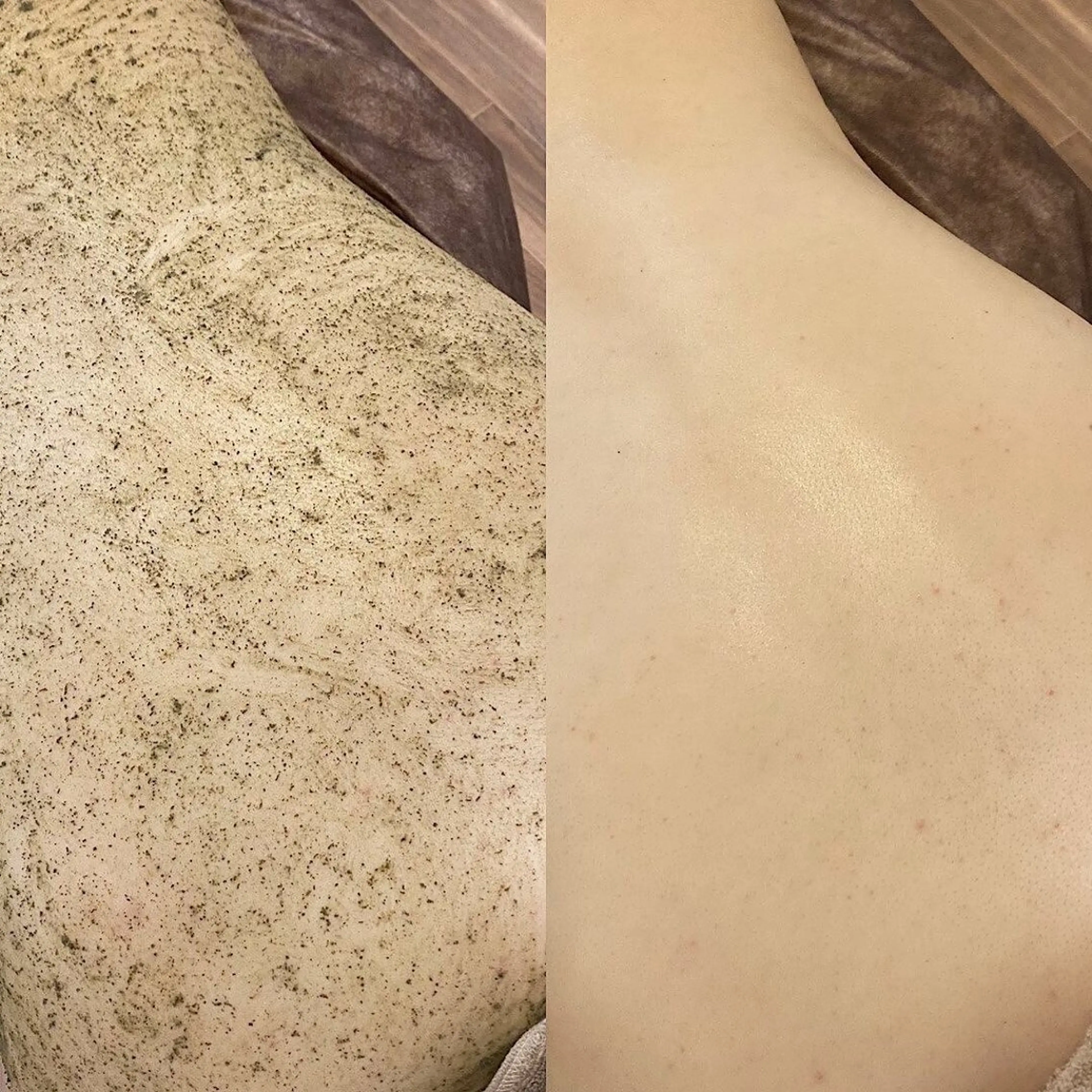 【背中&お顔のニキビケア】背面+お顔ハーブピーリング(剥離無)60分¥7830の写真