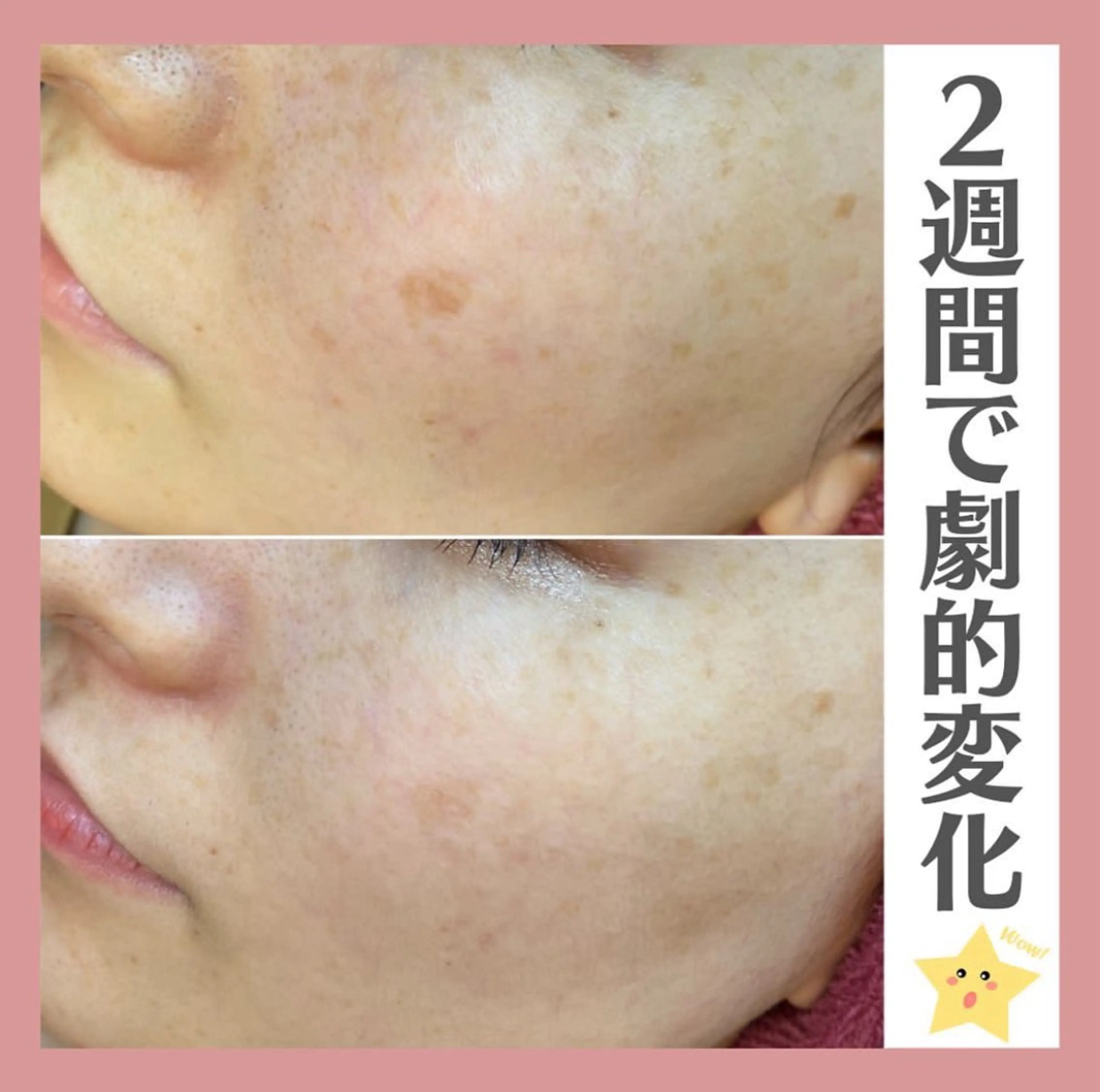 プラズマしみケア 5分 当て放題の写真